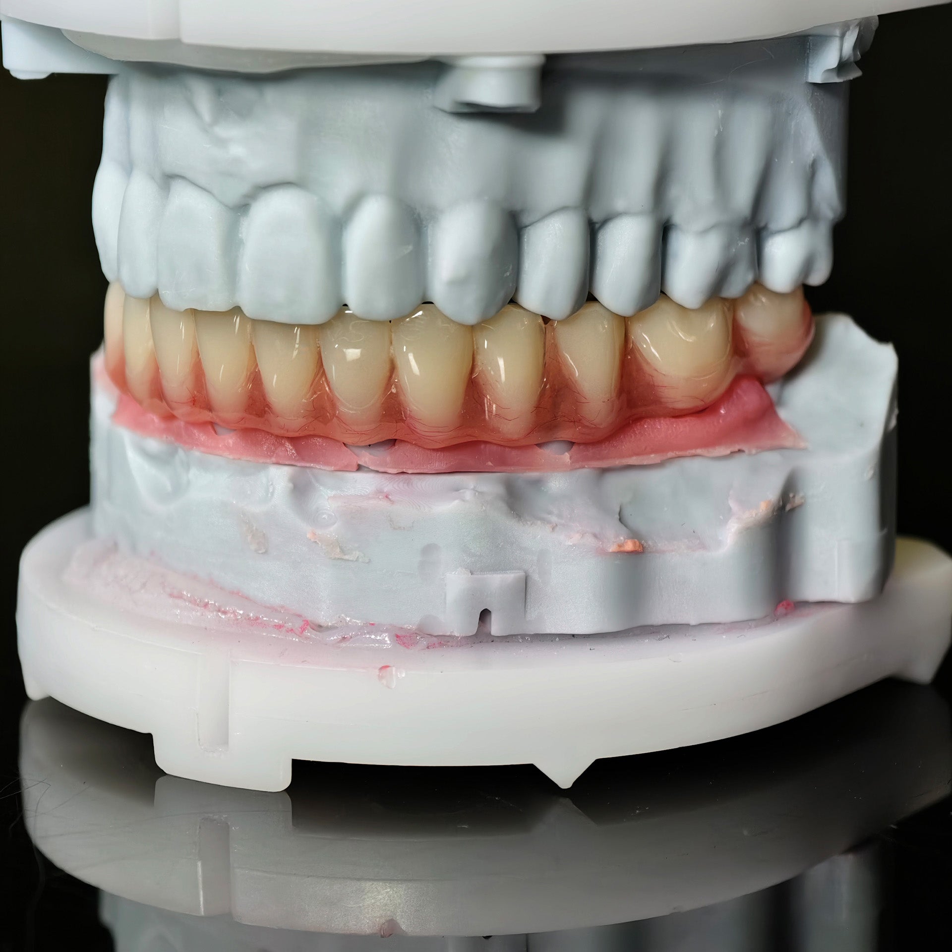 Acrylic Denture With Screw Retained
