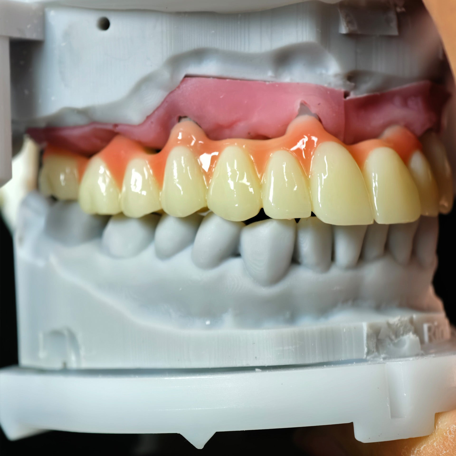 Custom Abutment And PMMA Bridge And Crown With Cement Retained