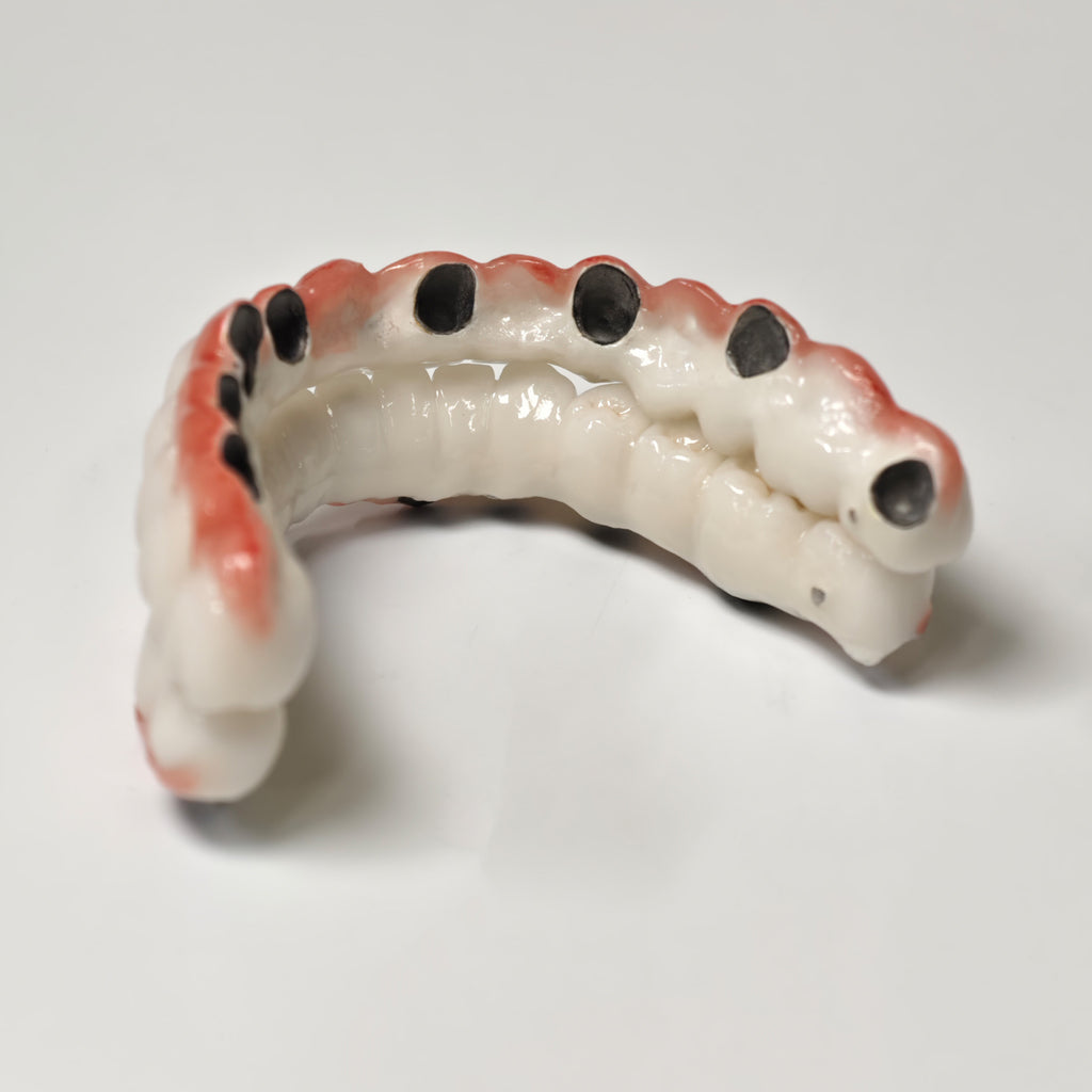 Full-Arch PFM Bridge With Screw Retained