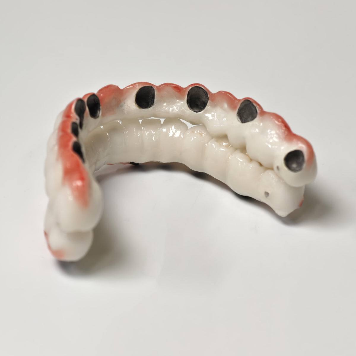 Full-Arch PFM Bridge With Screw Retained