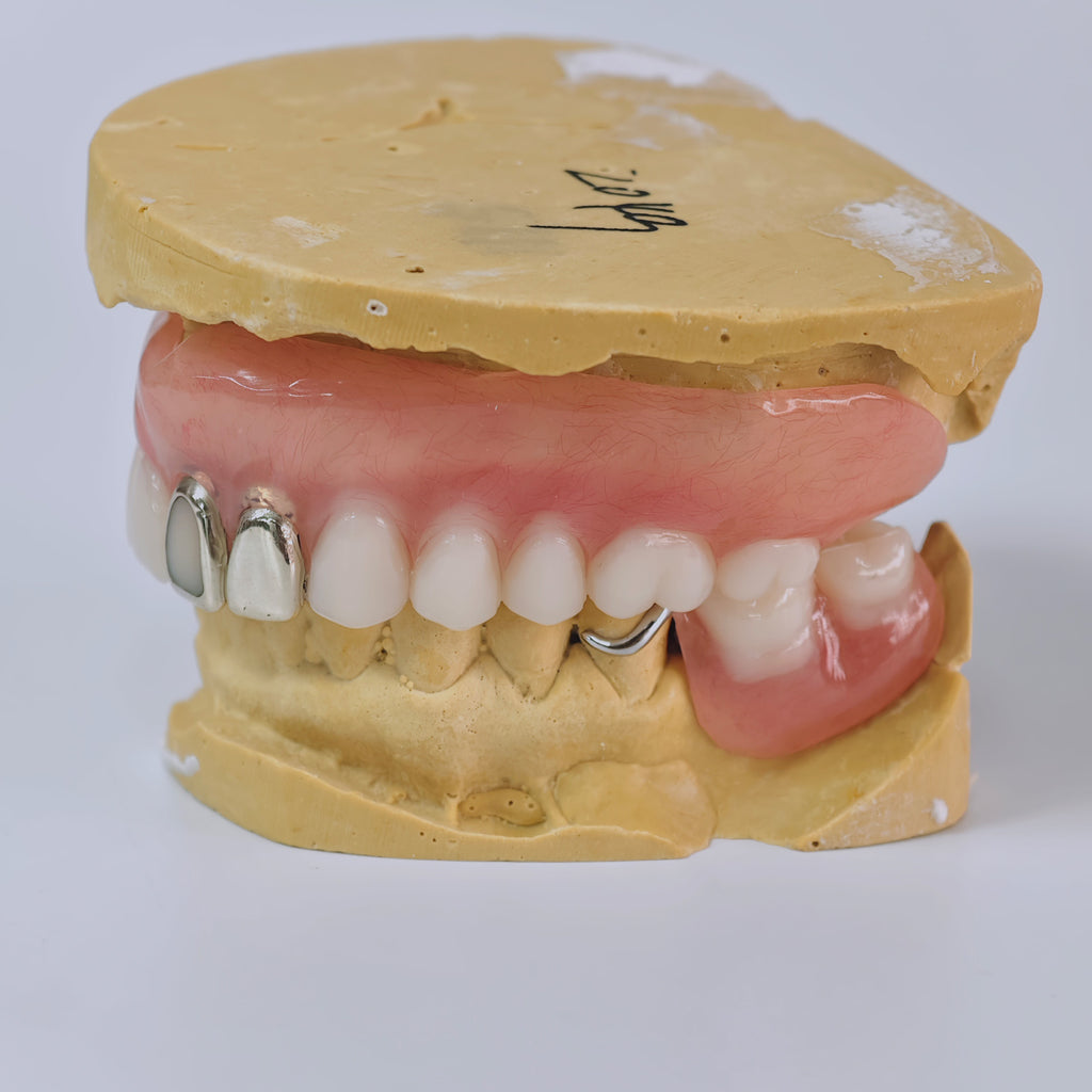 Full-Mouth Acrylic Denture