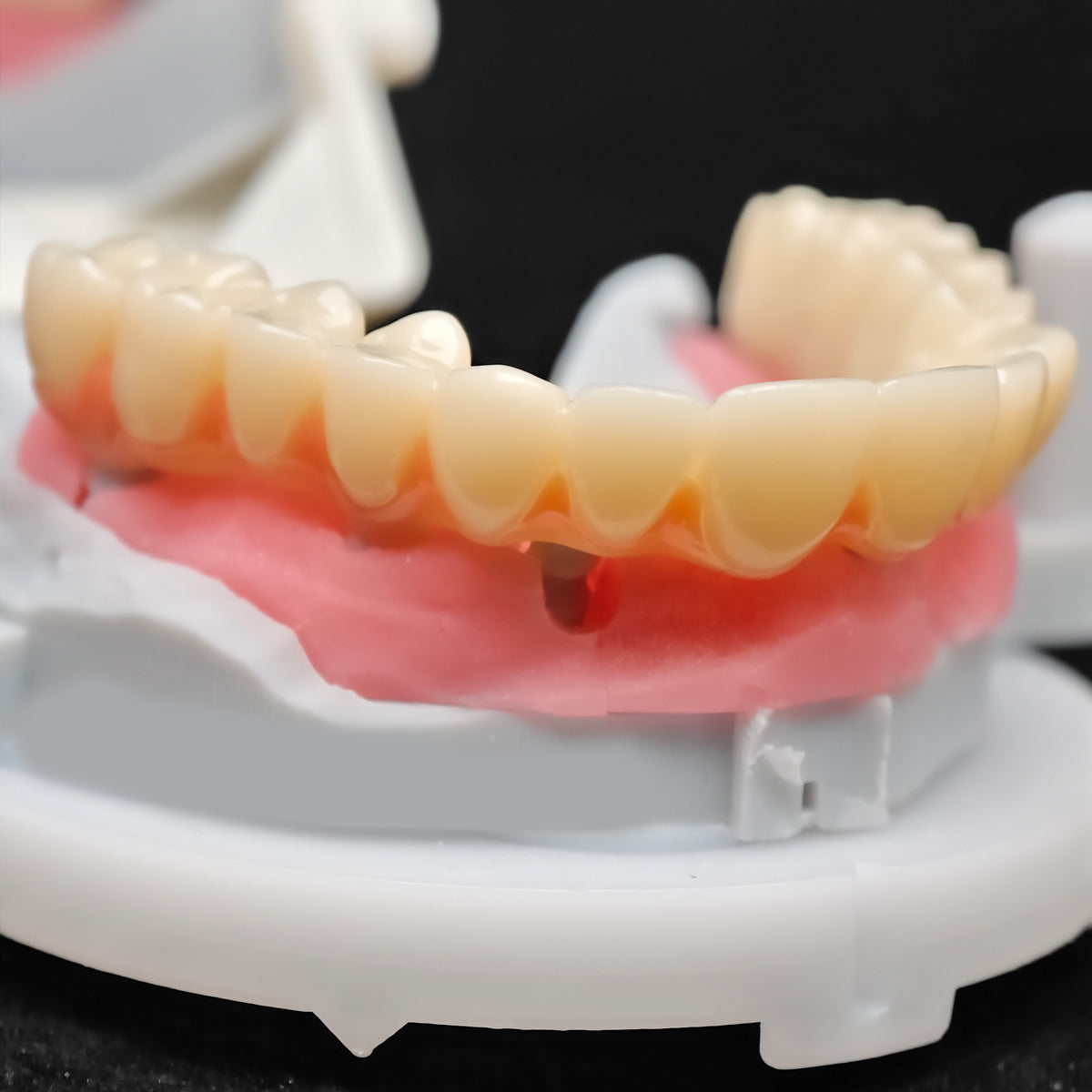 Pmma Bridge And Zirconia Bridge With Cemented