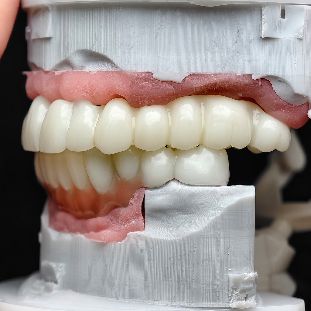 Pmma Bridge With Implant Seating Guide And Cemented