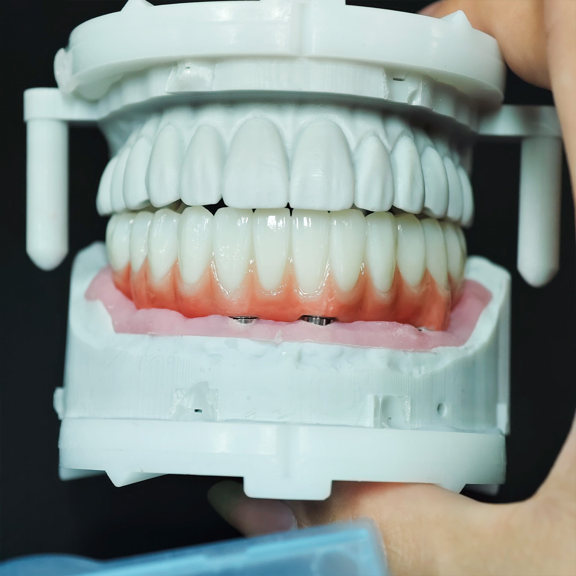 Zirconia Bridge With Ti-Base Abutment