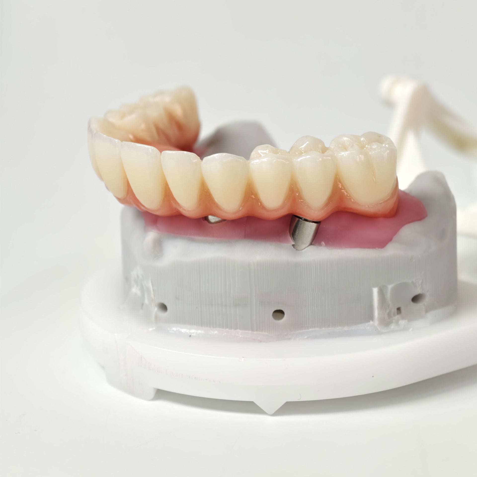All On 5 Zirconia Bridge With Ti-Base Screw Retained