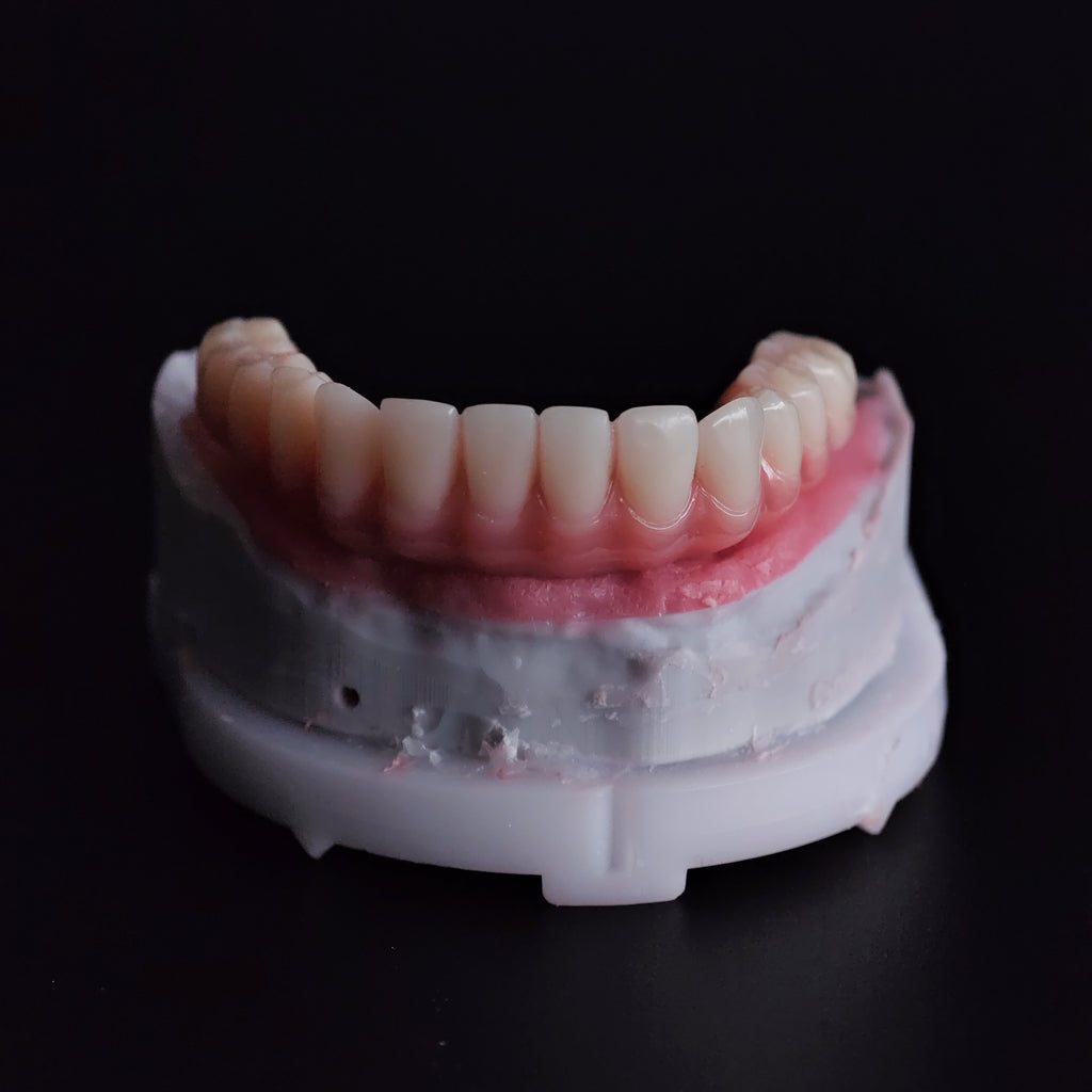 An Acrylic Denture With A Titanium Bar (Ti-Bar) Cost-Effective Full Arch Restoration Screw Retained