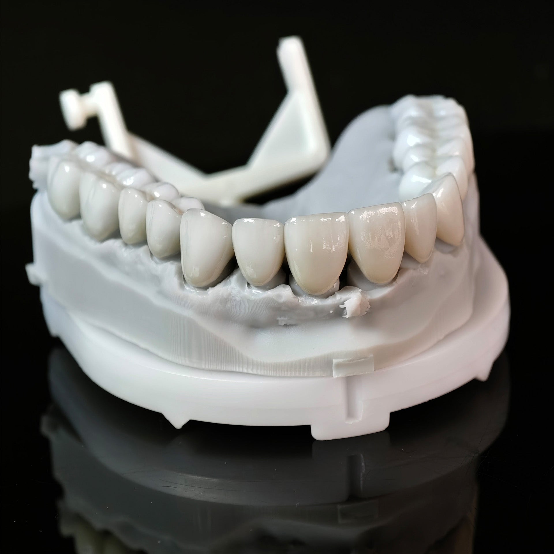 Ceramic Veneers And Crown With Cement Retained