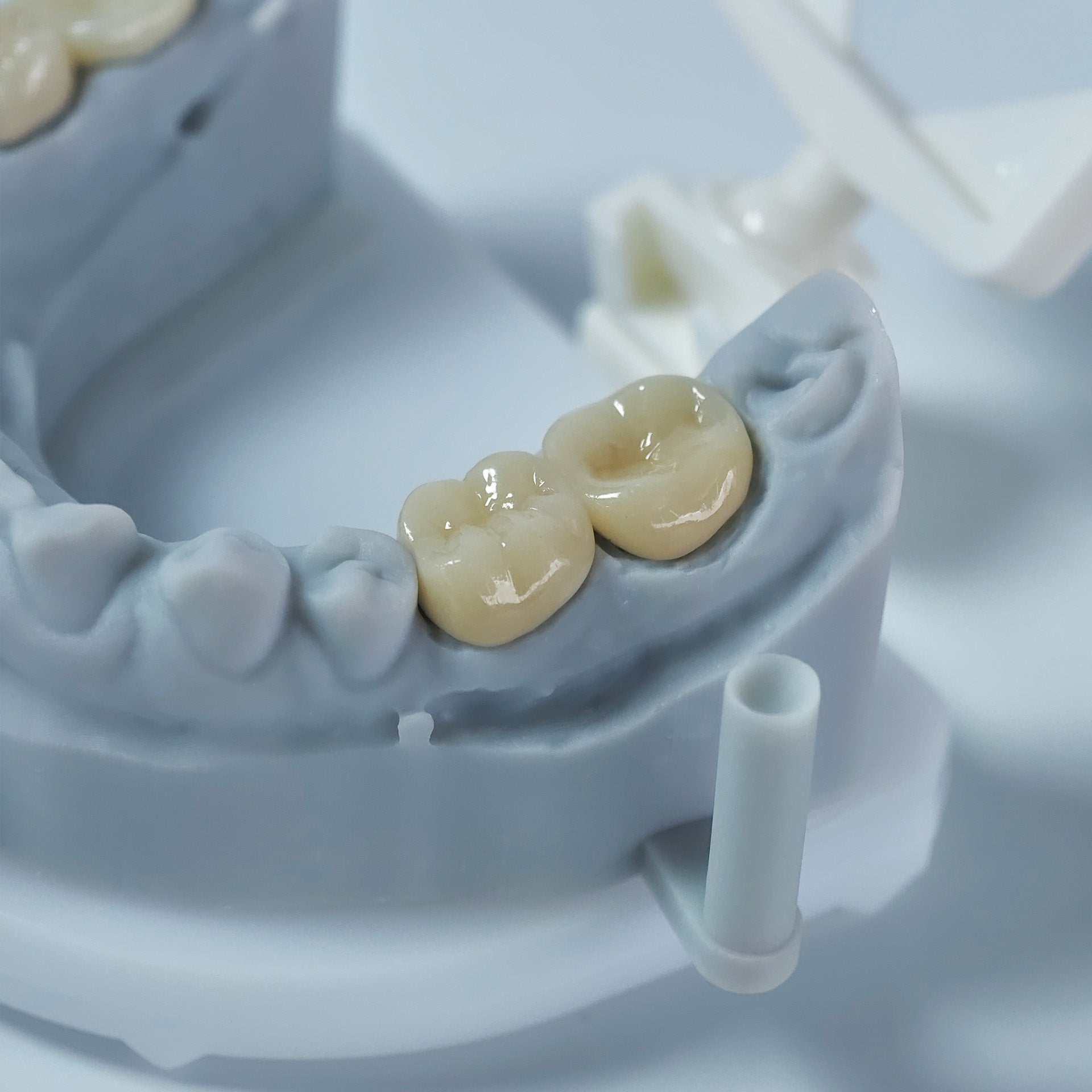 Co - Cr PFM Dental Crowns With Metal Post-And-Core