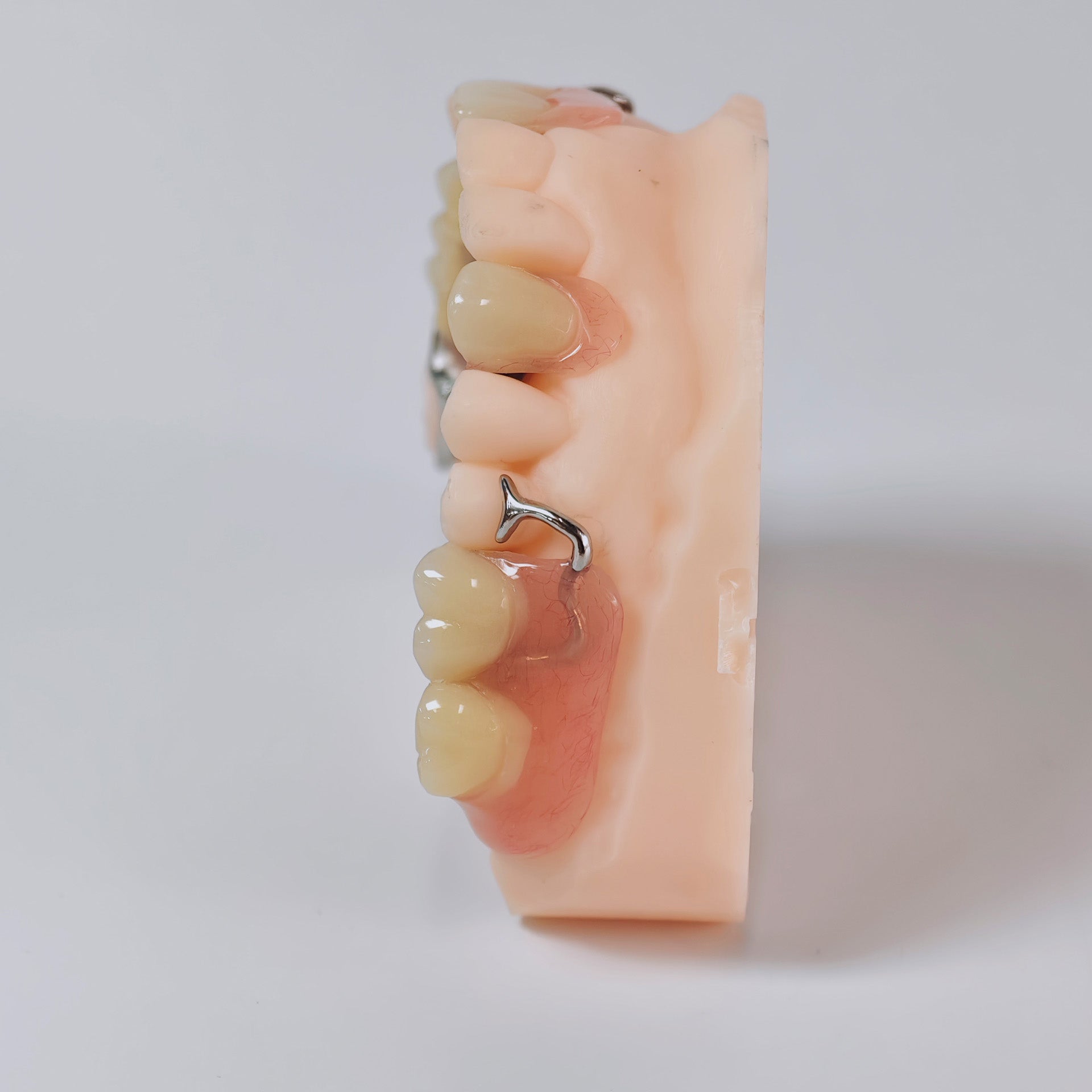 Cobalt Chrome Framework Denture Metal Framework With Acrylic Denture