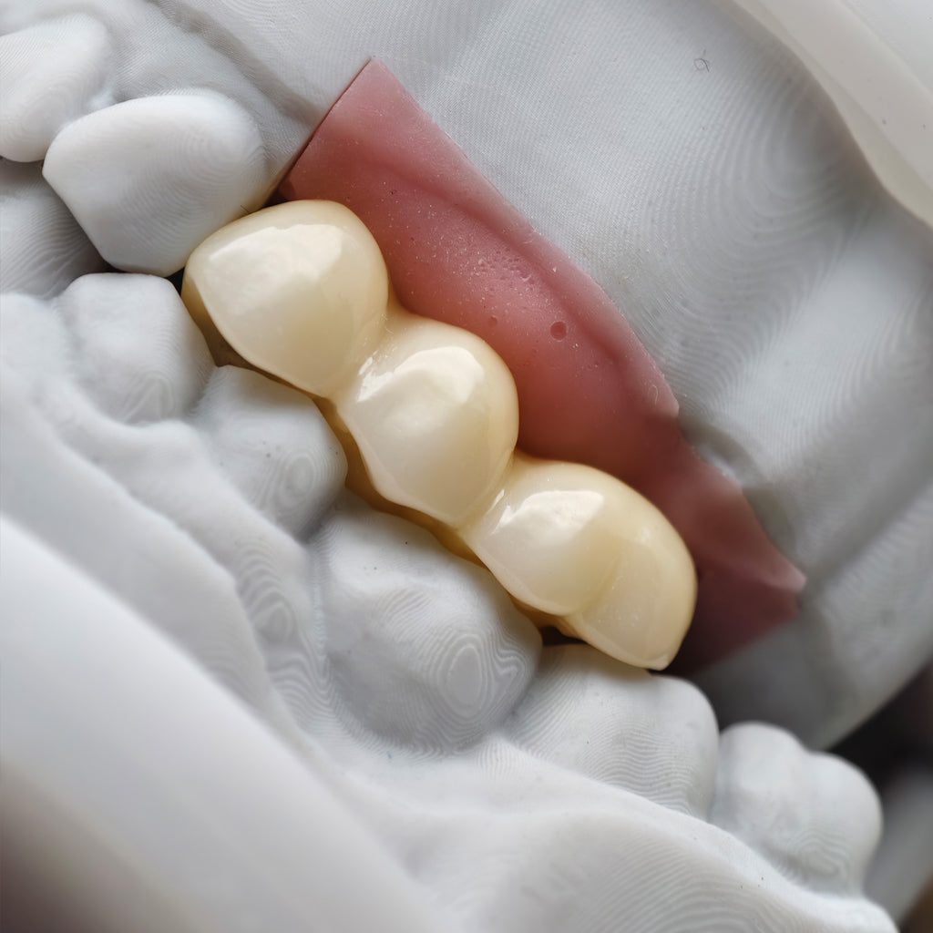 Custom Zirconia Implant Bridge