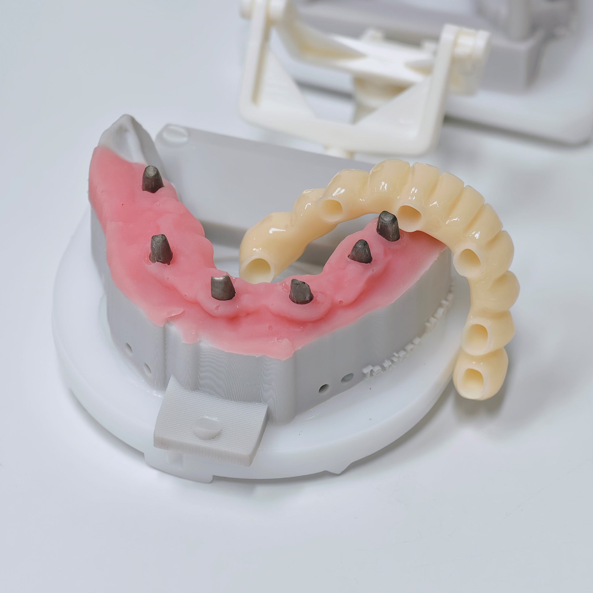 Custom Abutment And PMMA Bridge With Cement Retained And Implant Seating Guide