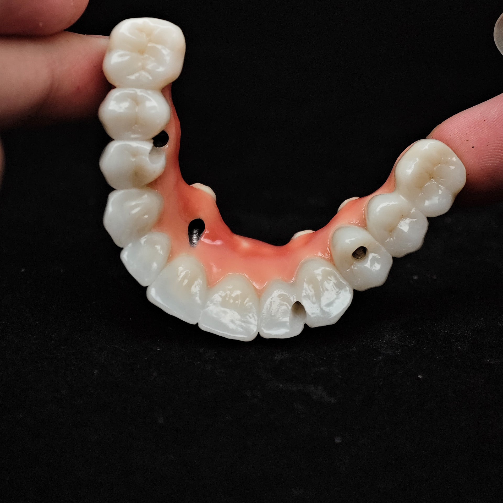 Enhanced Zirconia Crown Malo Bridge