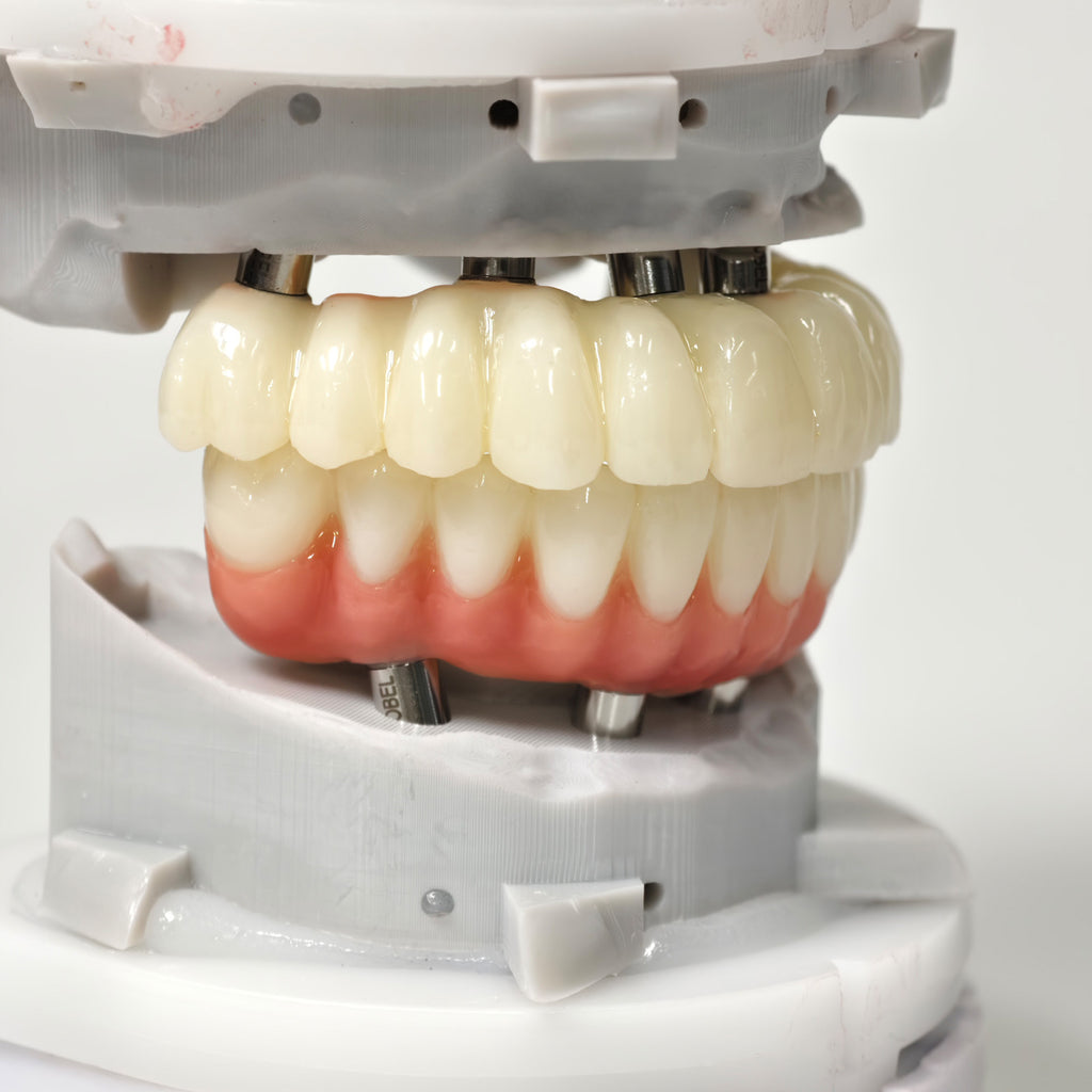 Full-Arch PMMA Bridge With Ti-Base Screw Retained