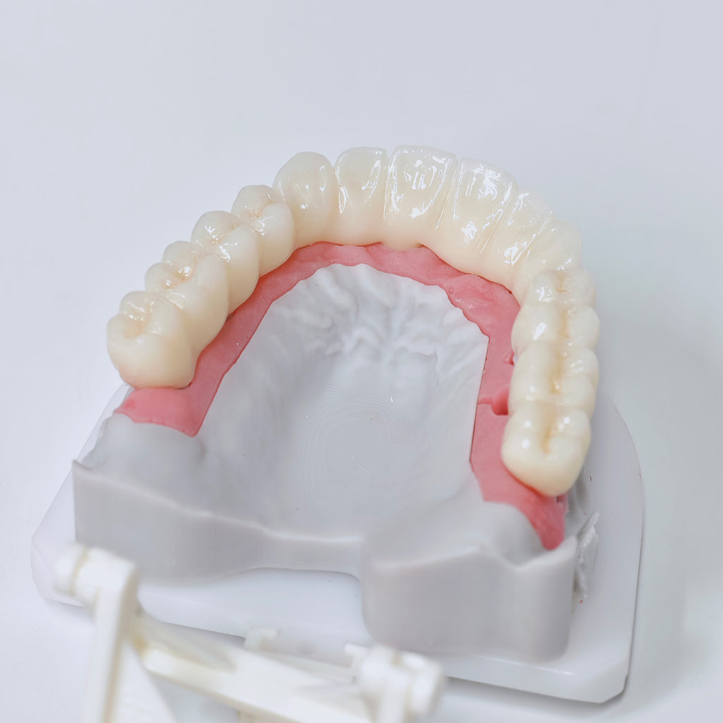 Half-Mouth Zirconia Bridge With Cement-Retained
