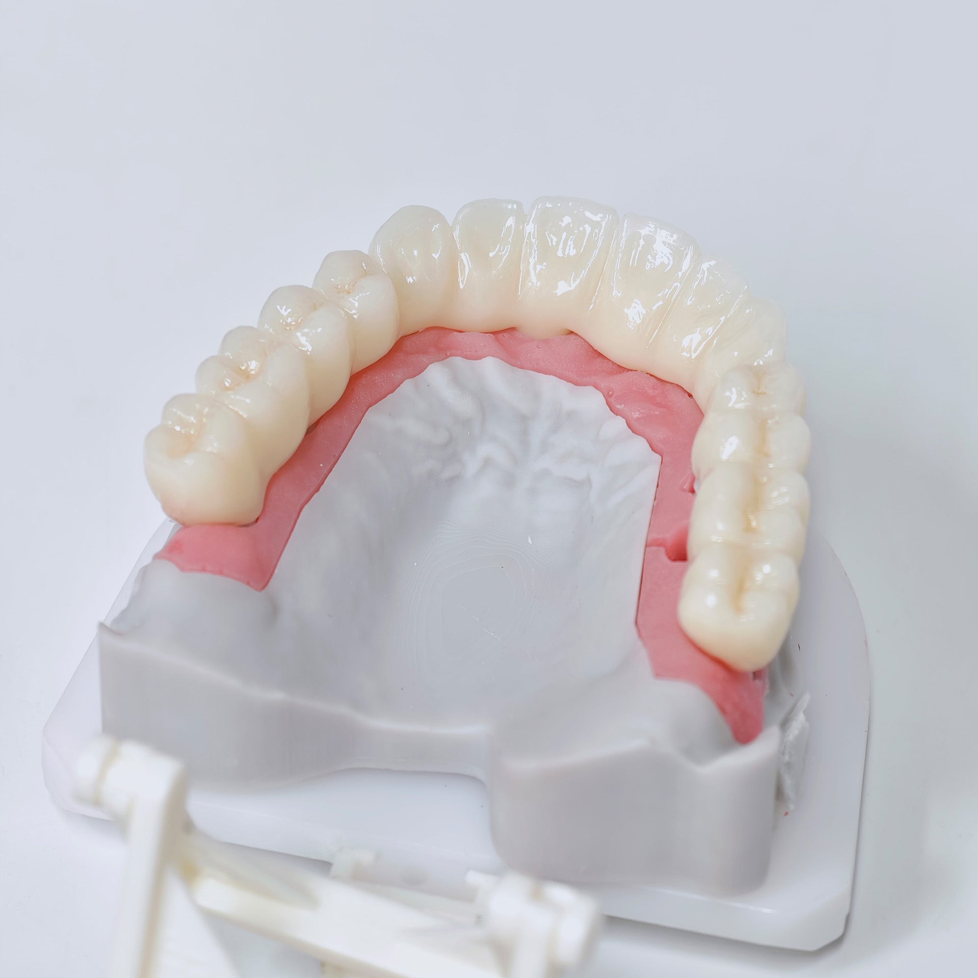 Half-Mouth Zirconia Bridge With Cement-Retained