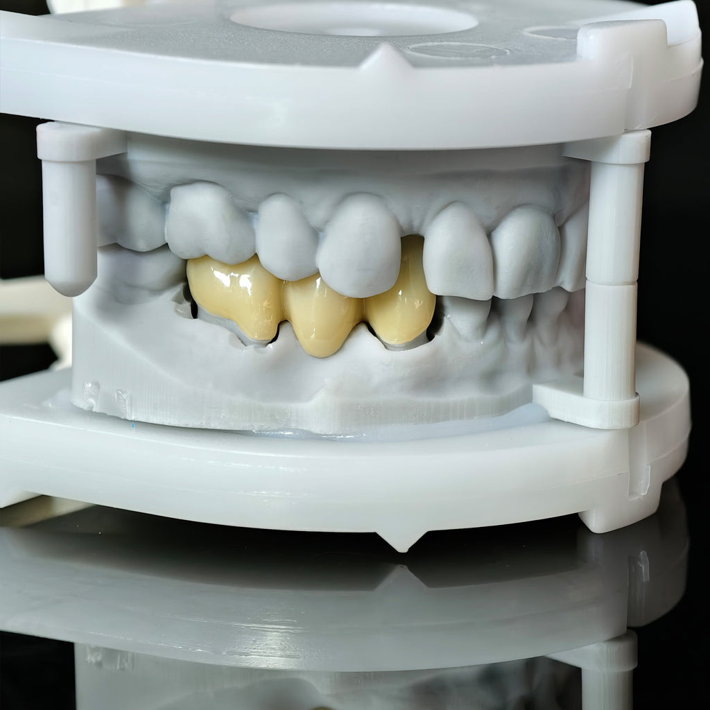 High - Strength Zirconia Bridge
