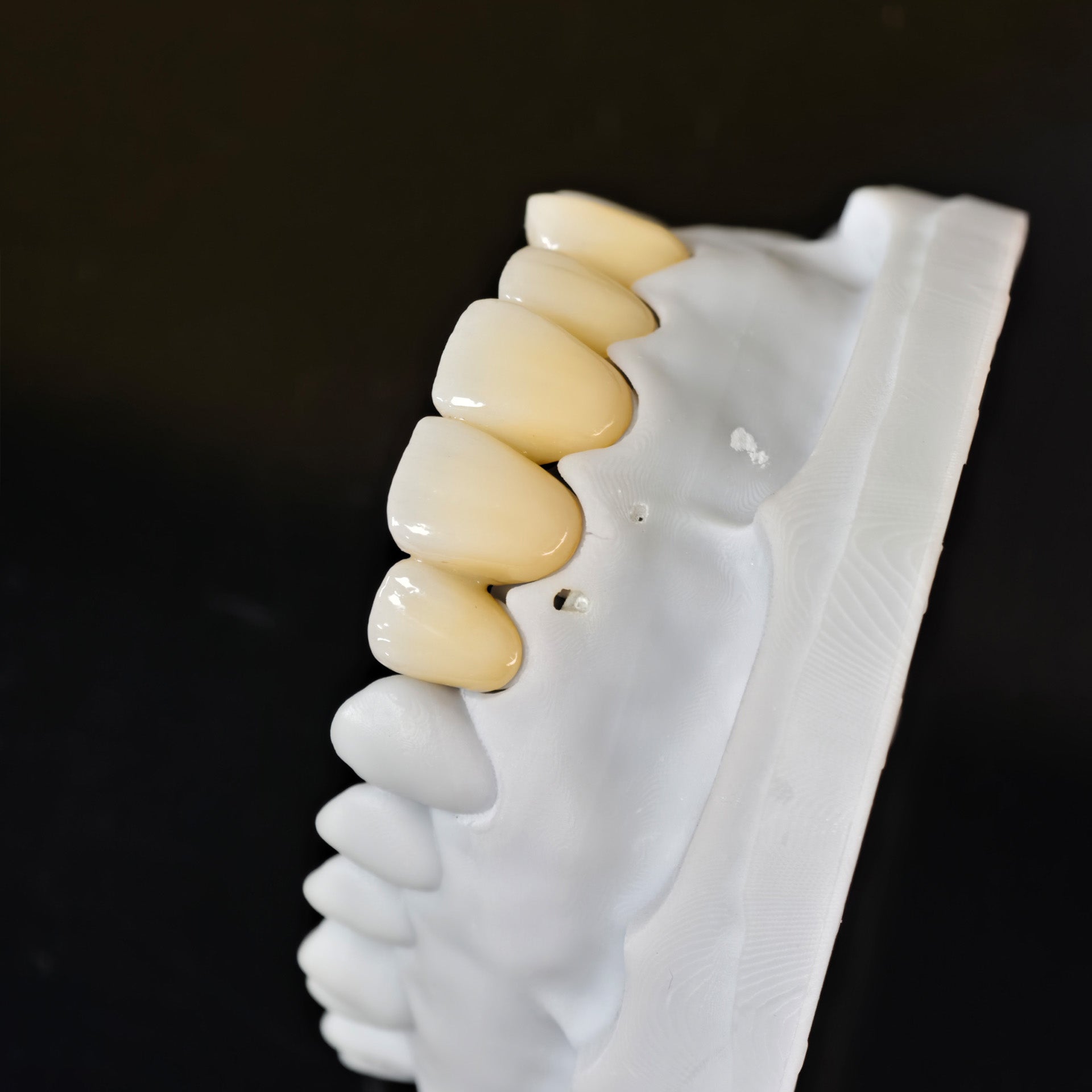 High - Strength Zirconia Bridge