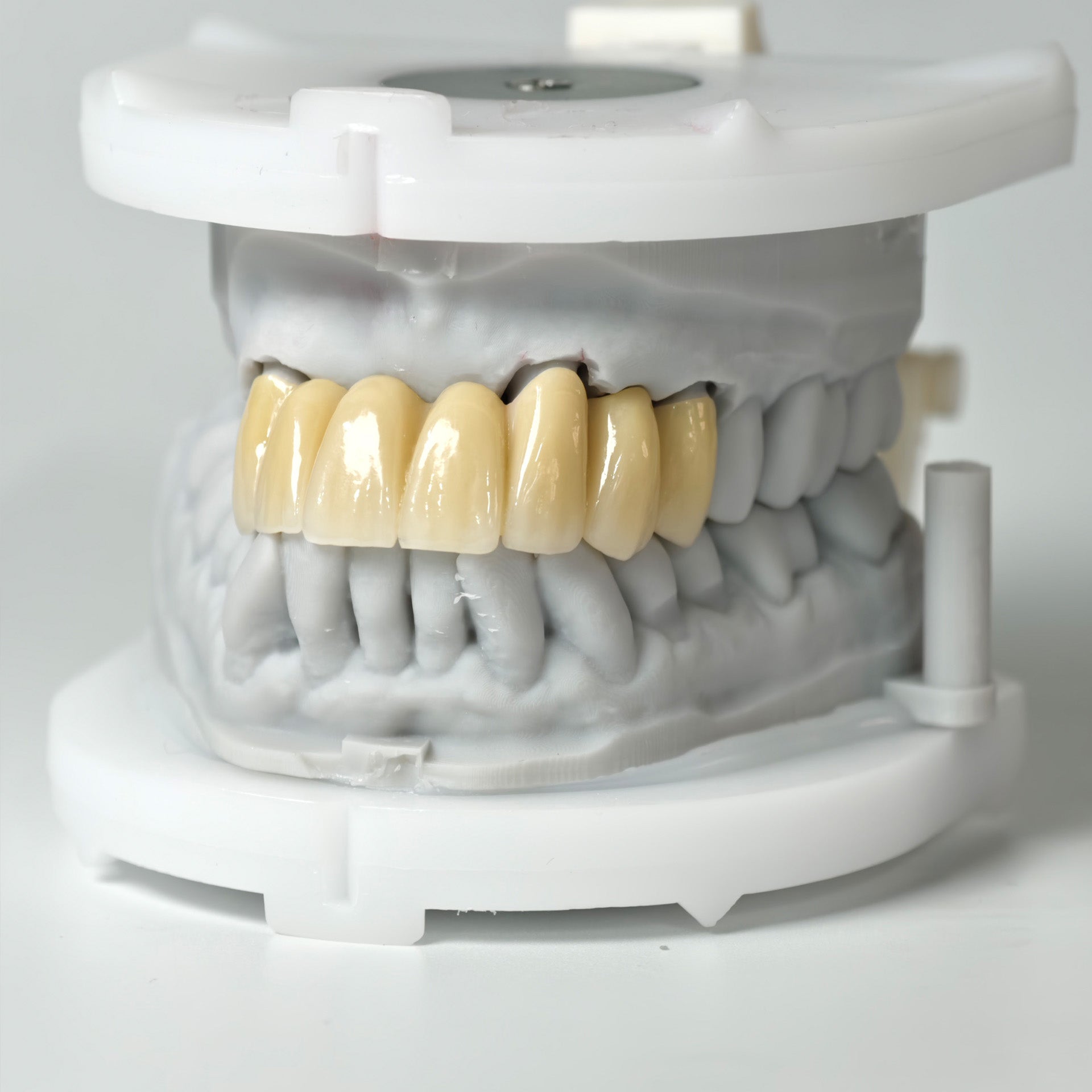 High - Strength Zirconia Bridge