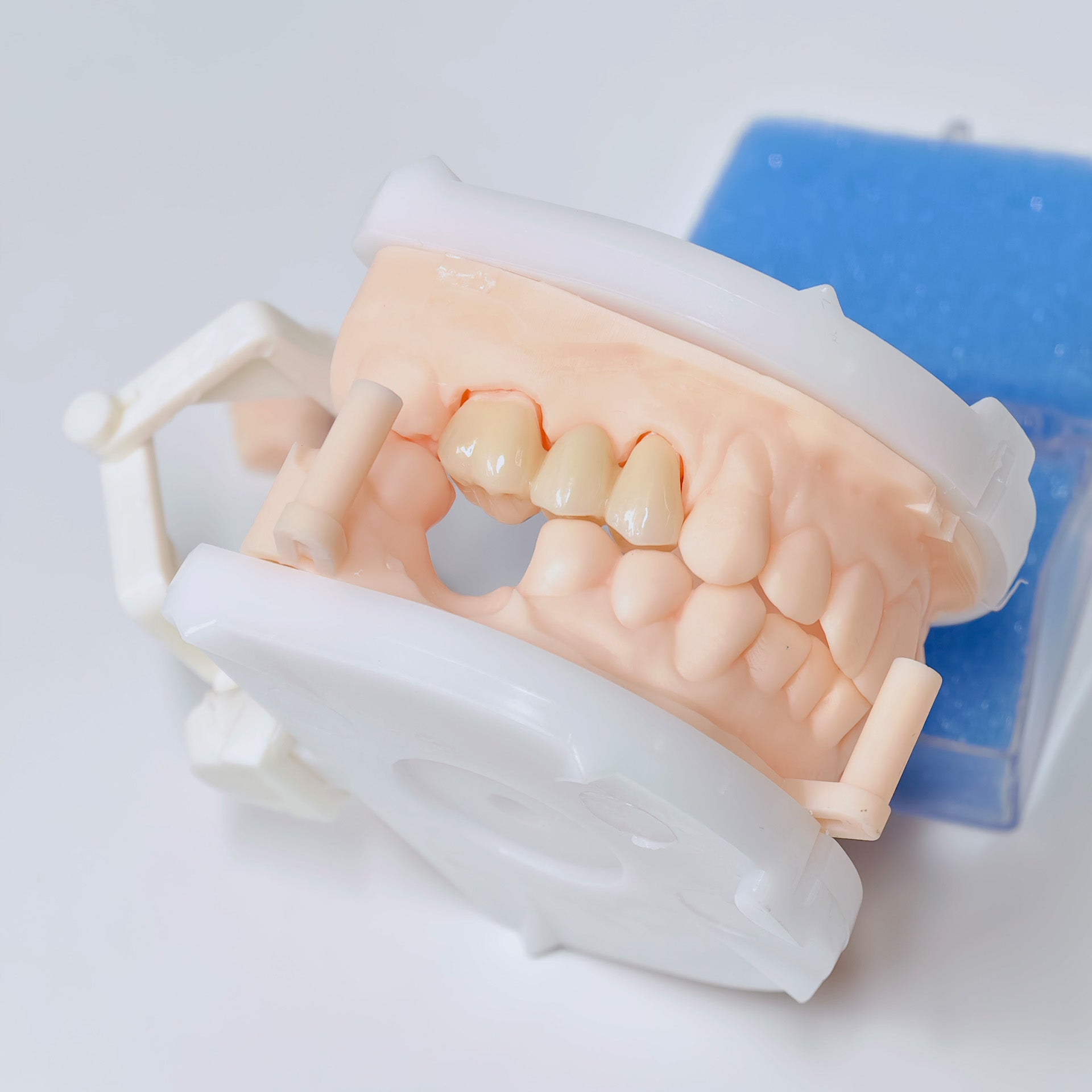 High - Strength Zirconia Bridge