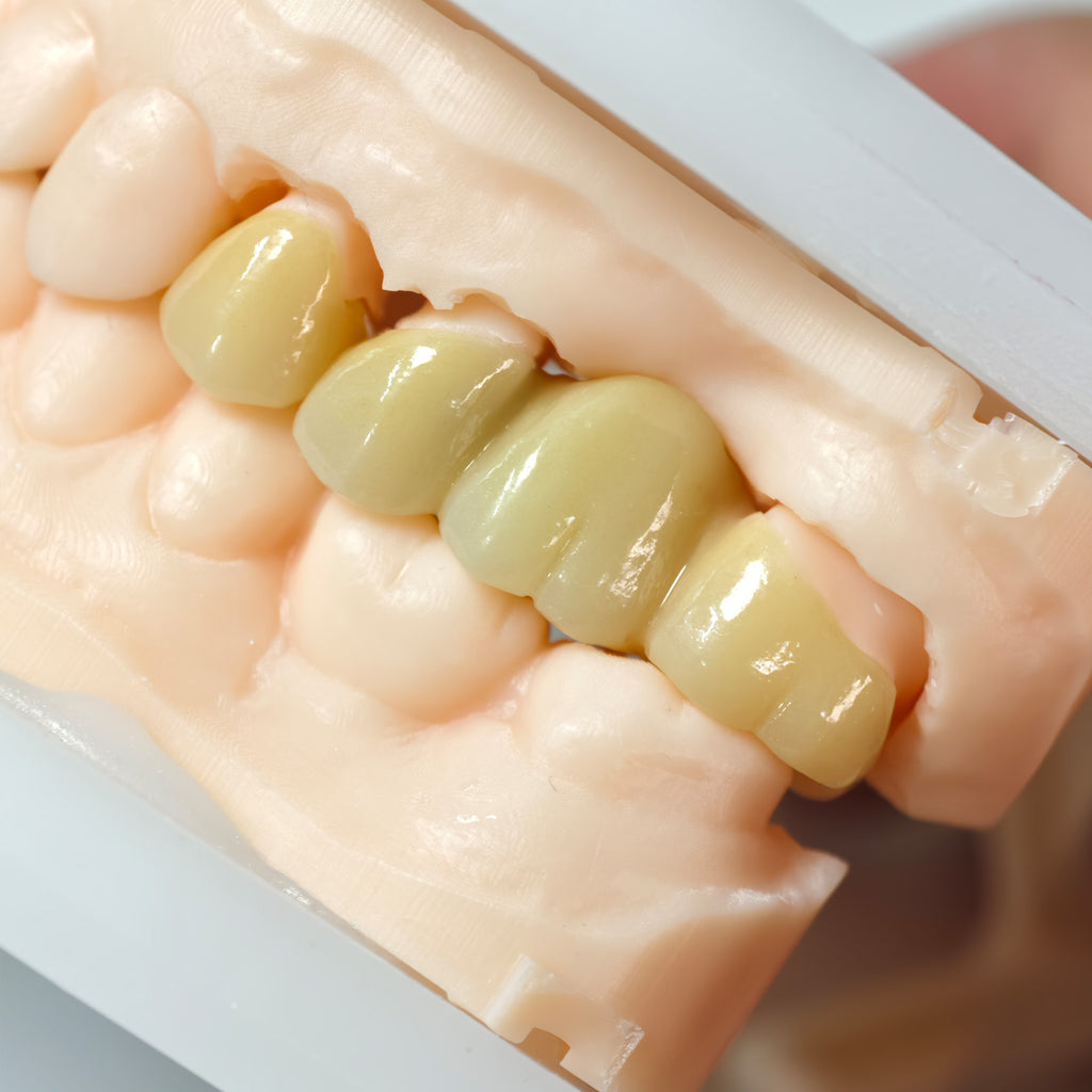High - Strength Zirconia Bridge And Crown