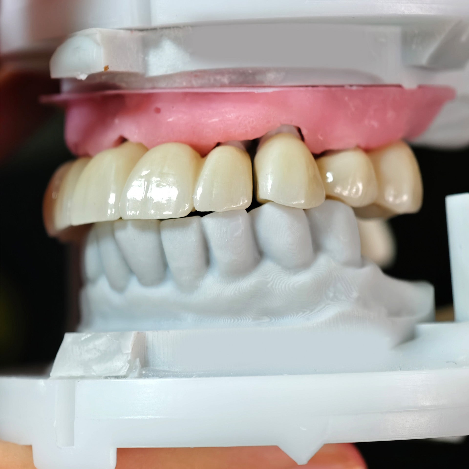 High - Strength Zirconia Crowns And Bridge