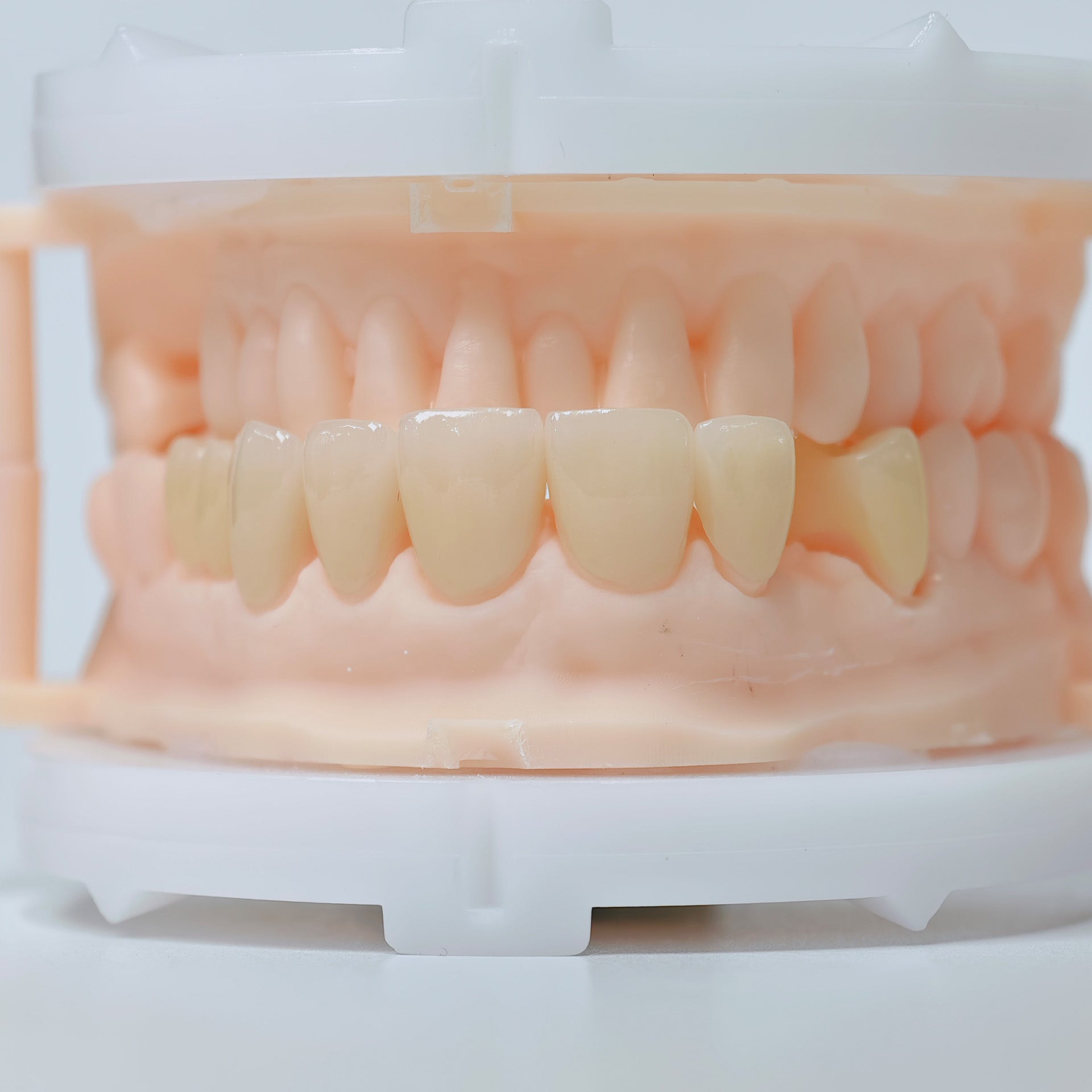 High - Strength Zirconia Crowns And Ceramic Veneers