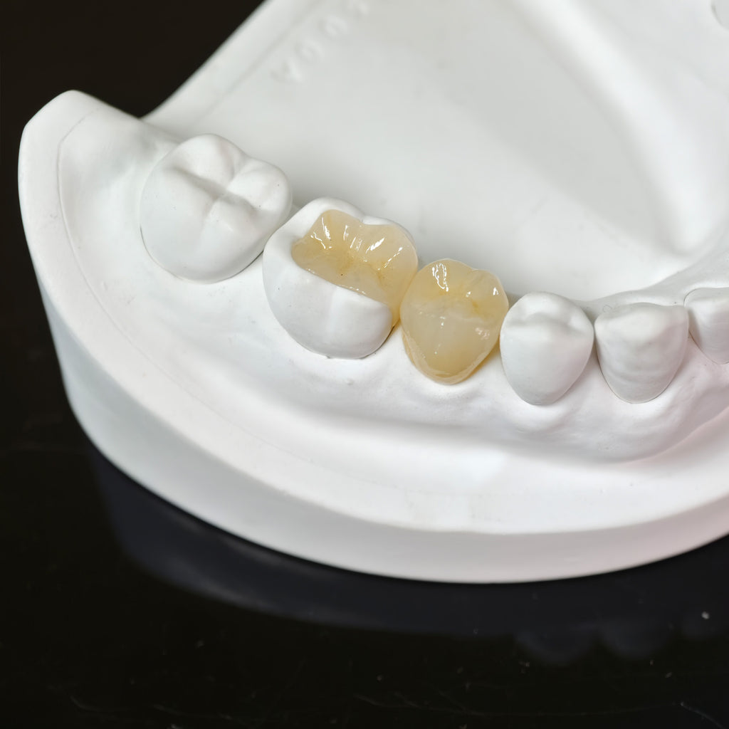 High - Strength Zirconia Inlay And Crown