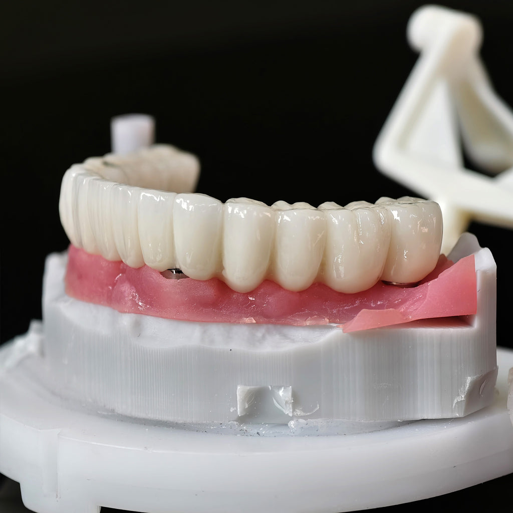 Implant-supported Co - Cr PFM Dental Bridge