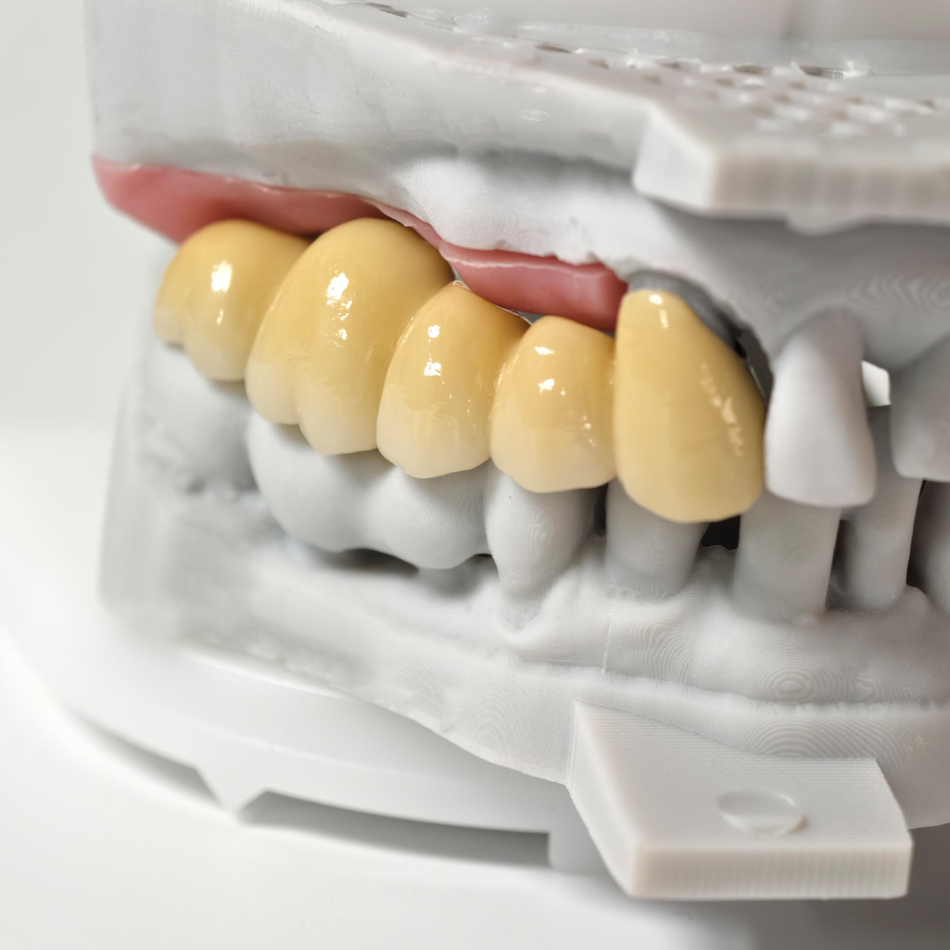 Implant-Supported PFM Single Bridge
