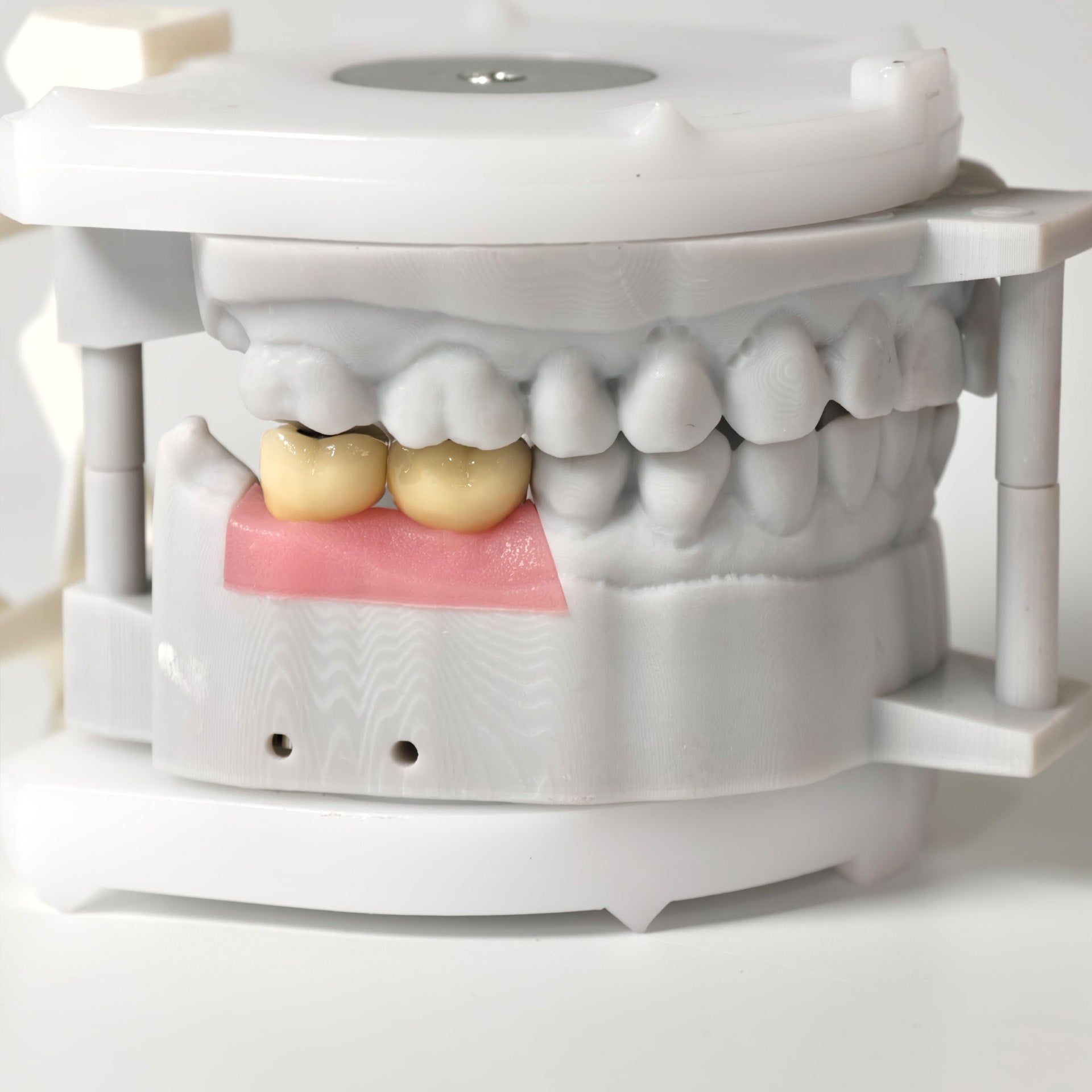 Implant-Supported PFM Single Crowns