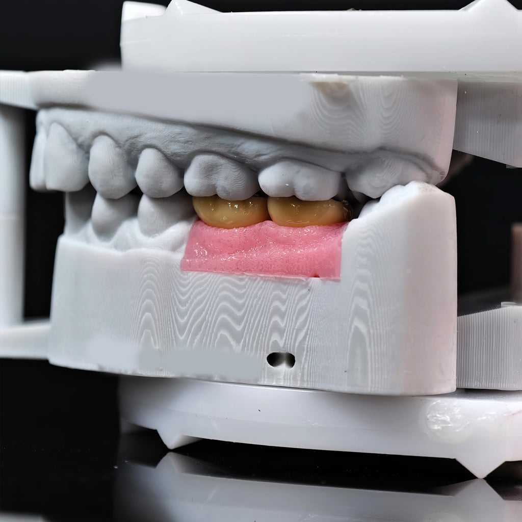 Implant-Supported PFM Single Crowns