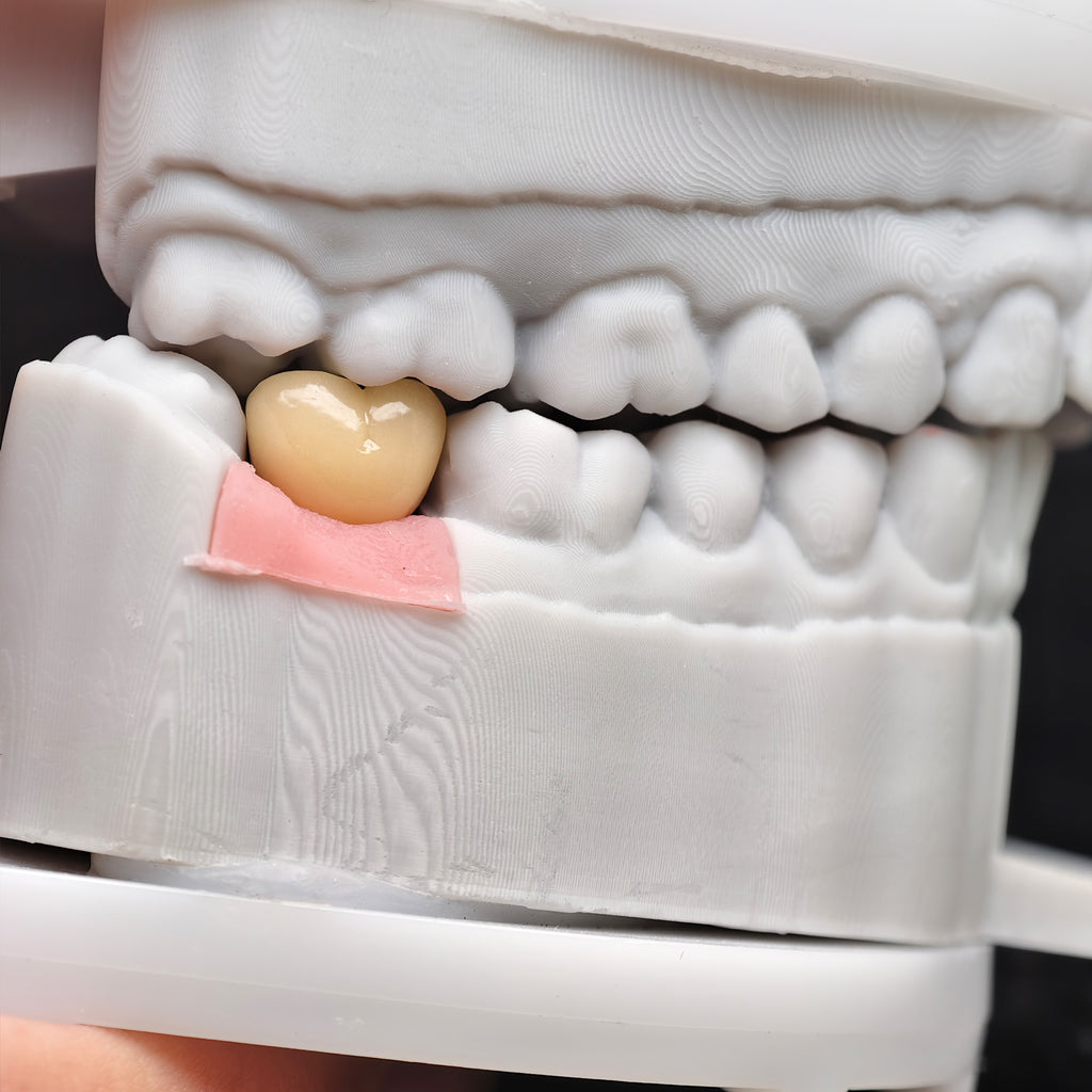 Implant-Supported PFM Single Crown With Metal