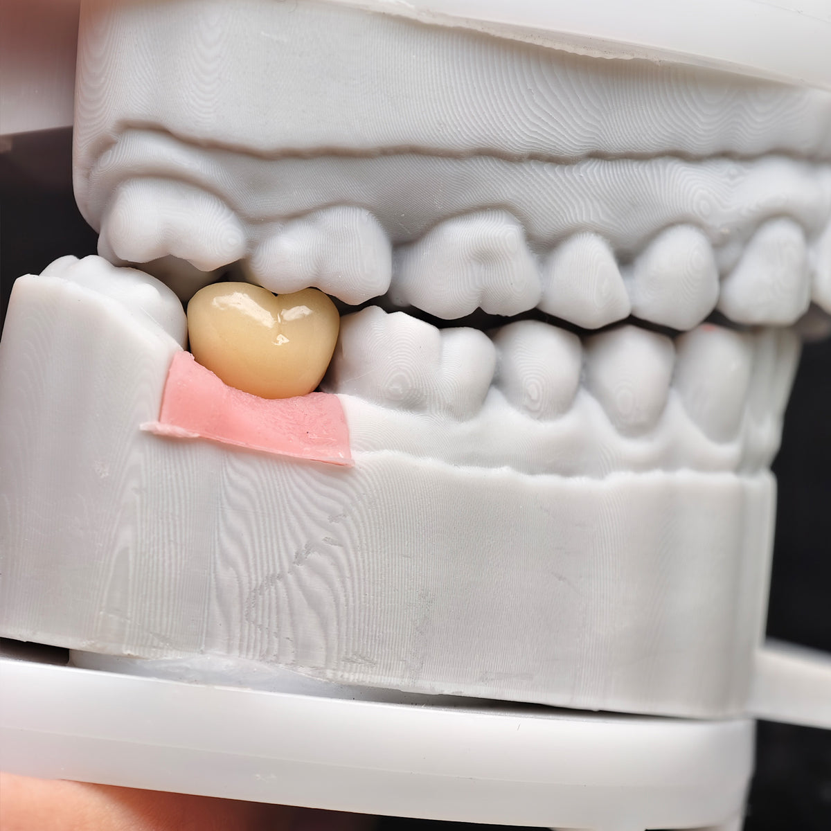 Implant-Supported PFM Single Crown With Metal