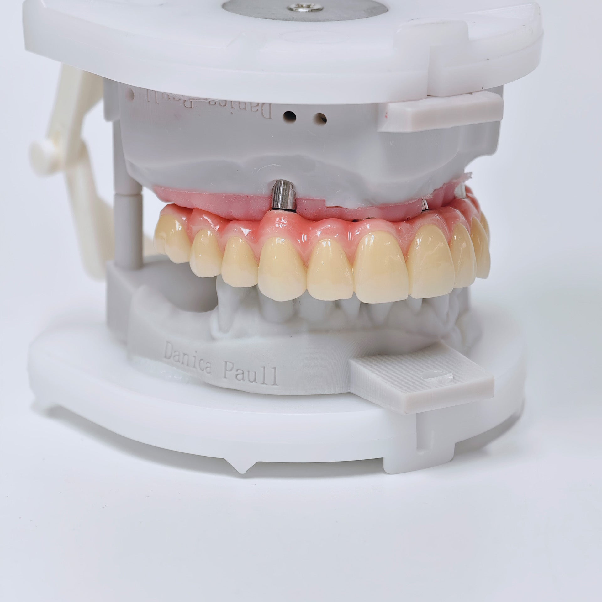 Malo Bridge With Screw-Retained