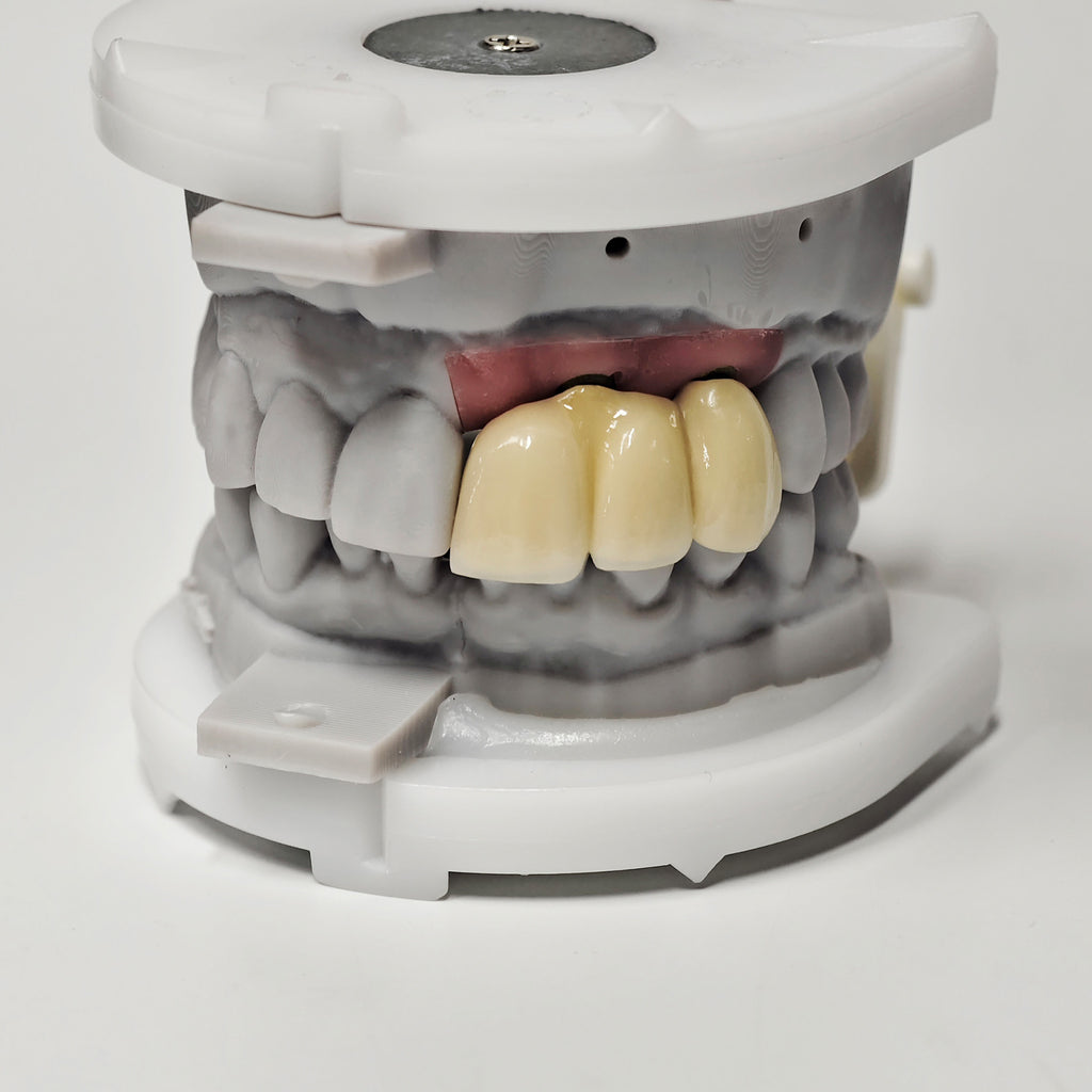 PFM Bridge With Screw-Retained And Implant Seating Guide