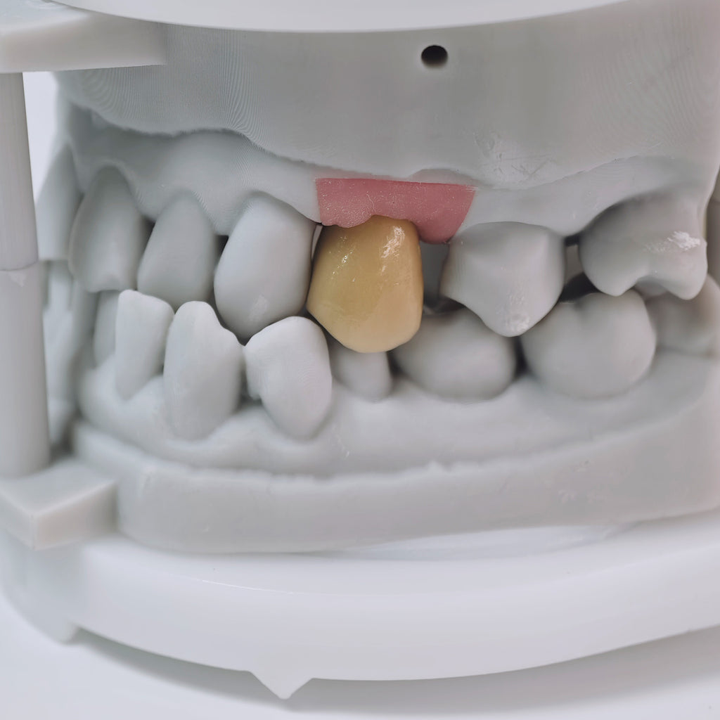 PFM Crown With Screw Retained