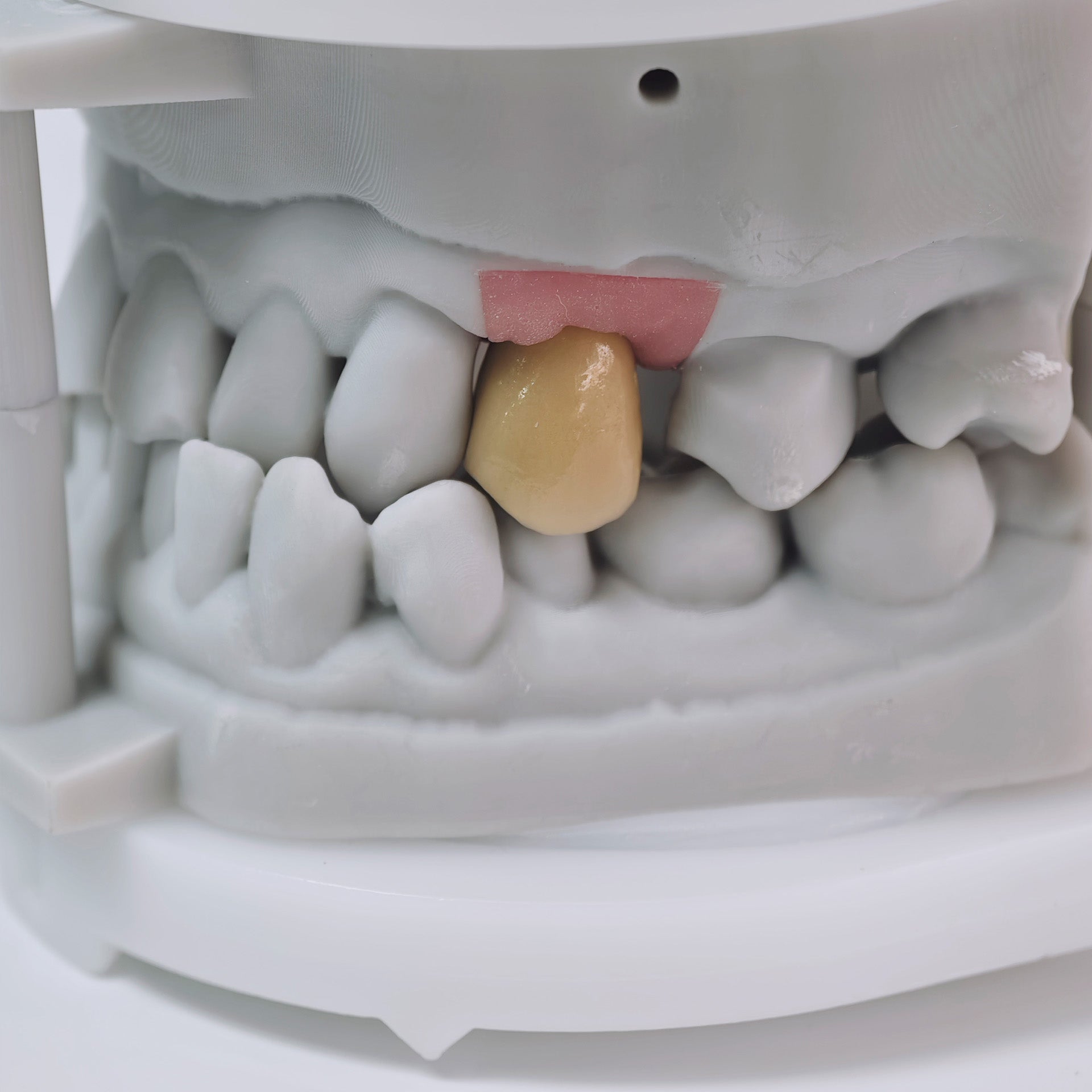 PFM Crown With Screw Retained