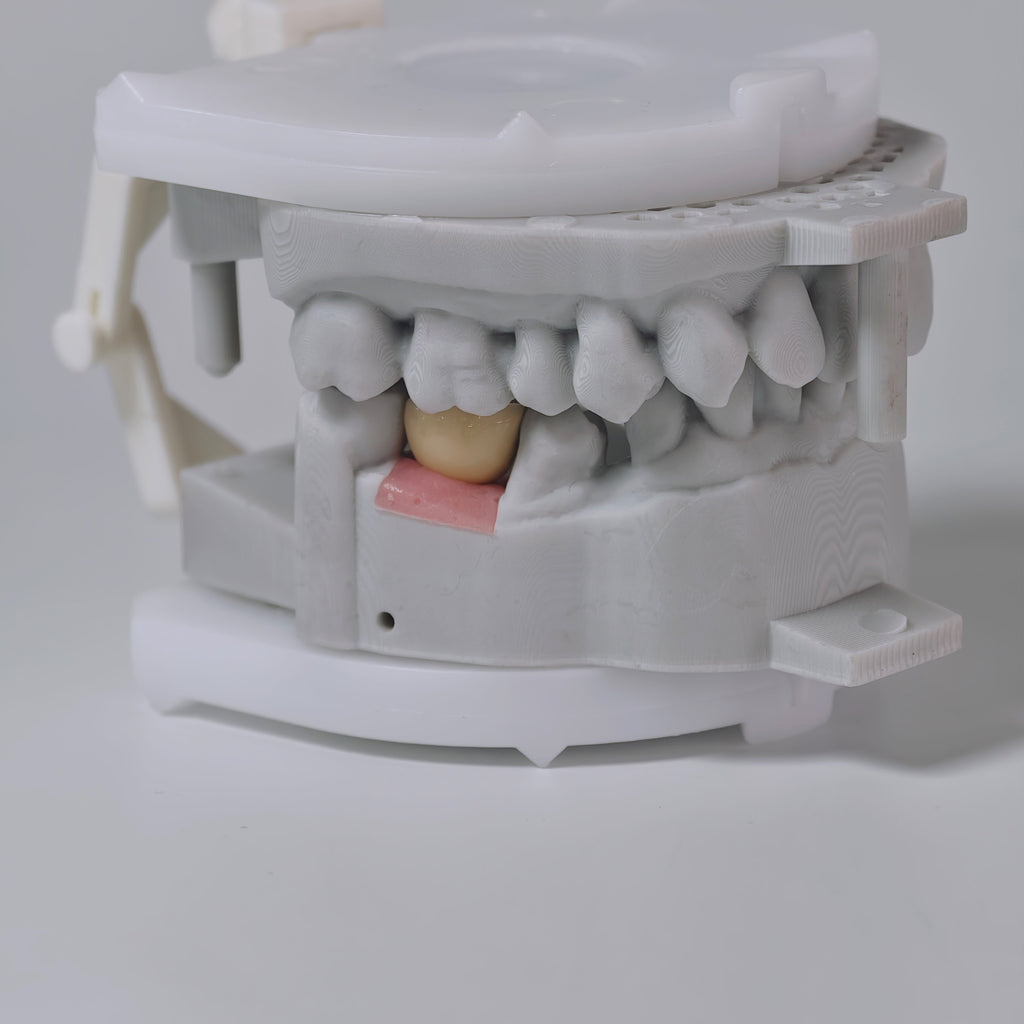 PFM Crown With Screw Retained
