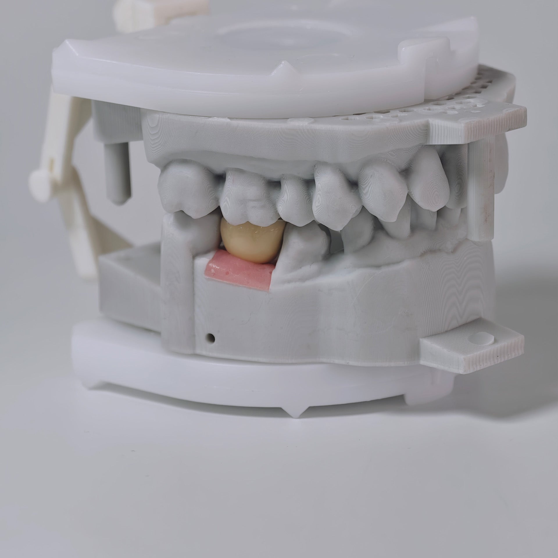 PFM Crown With Screw Retained