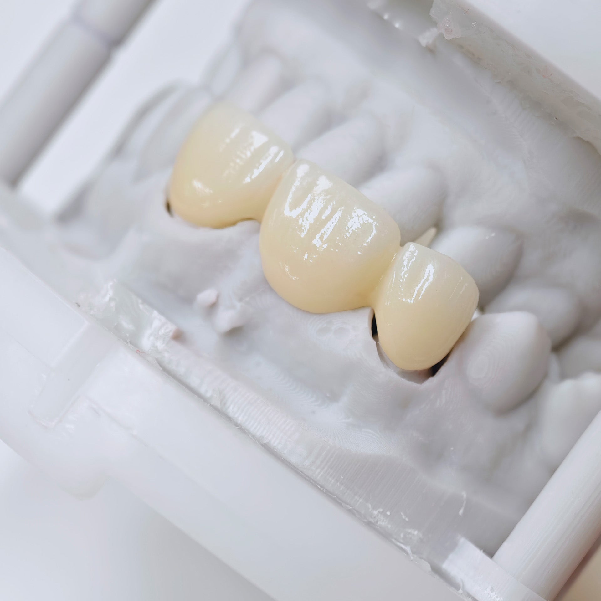 PFZ Dental Bridge – Depth And Aesthetics