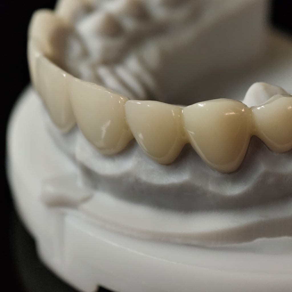 PMMA Bridge Veneer With Cement Retained