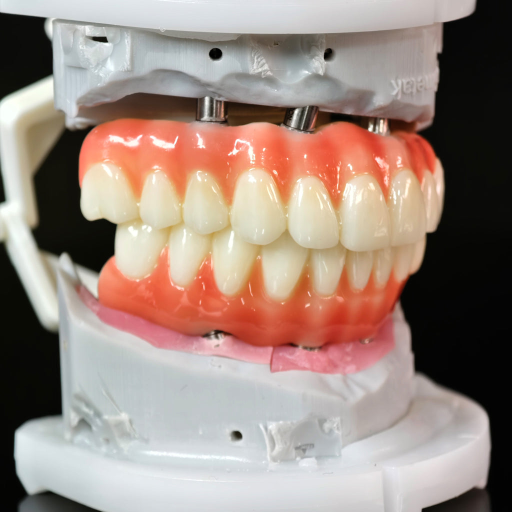 PMMA Bridge With Ti-Base Screw Retained Trying For Full Arch Restoration