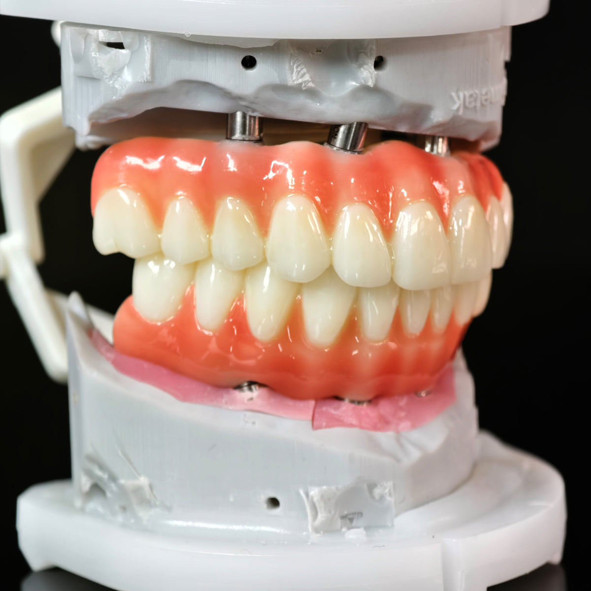 PMMA Bridge With Ti-Base Screw Retained Trying For Full Arch Restoration