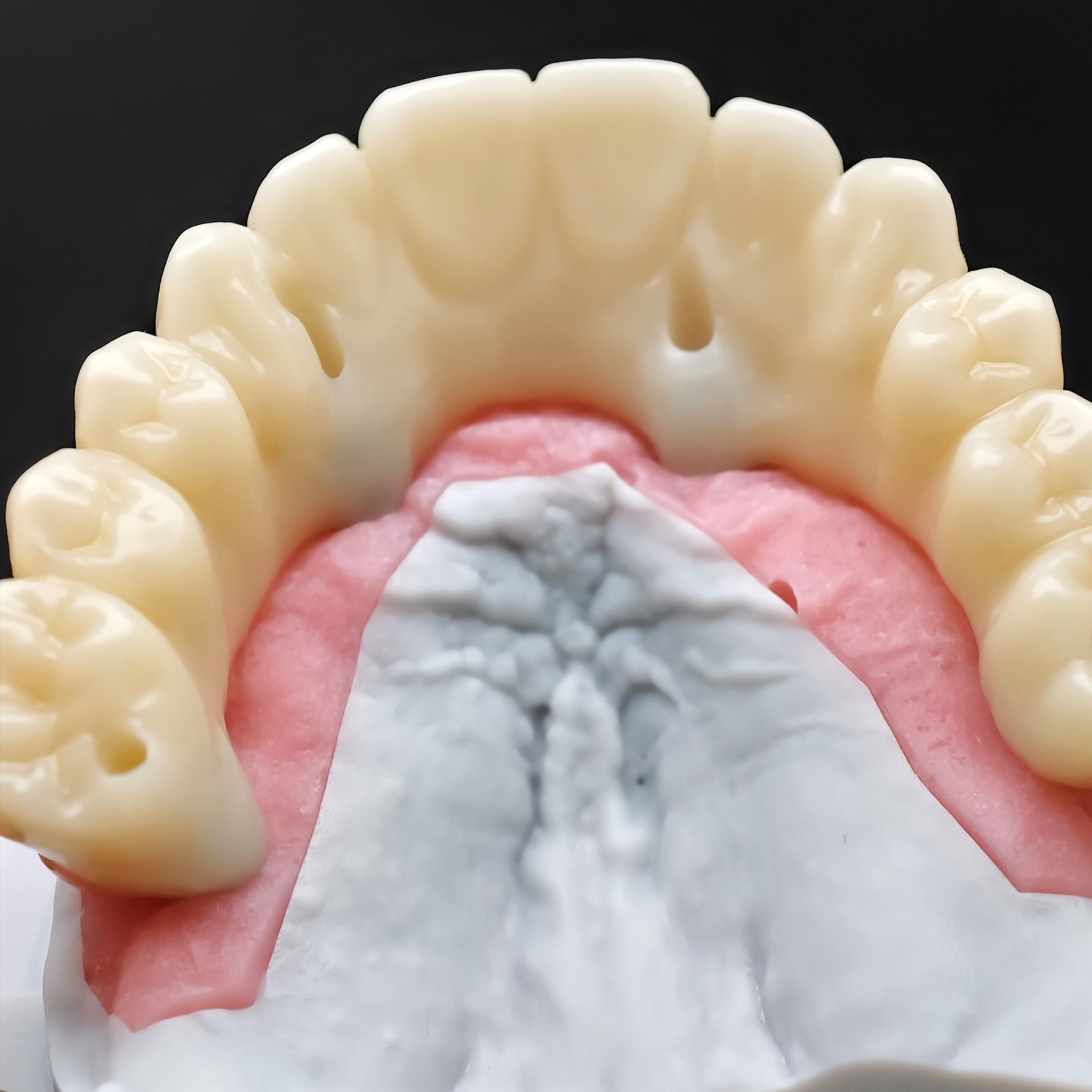 PMMA Bridge With Ti-Base Screw Retained Trying For Full Arch Restoration