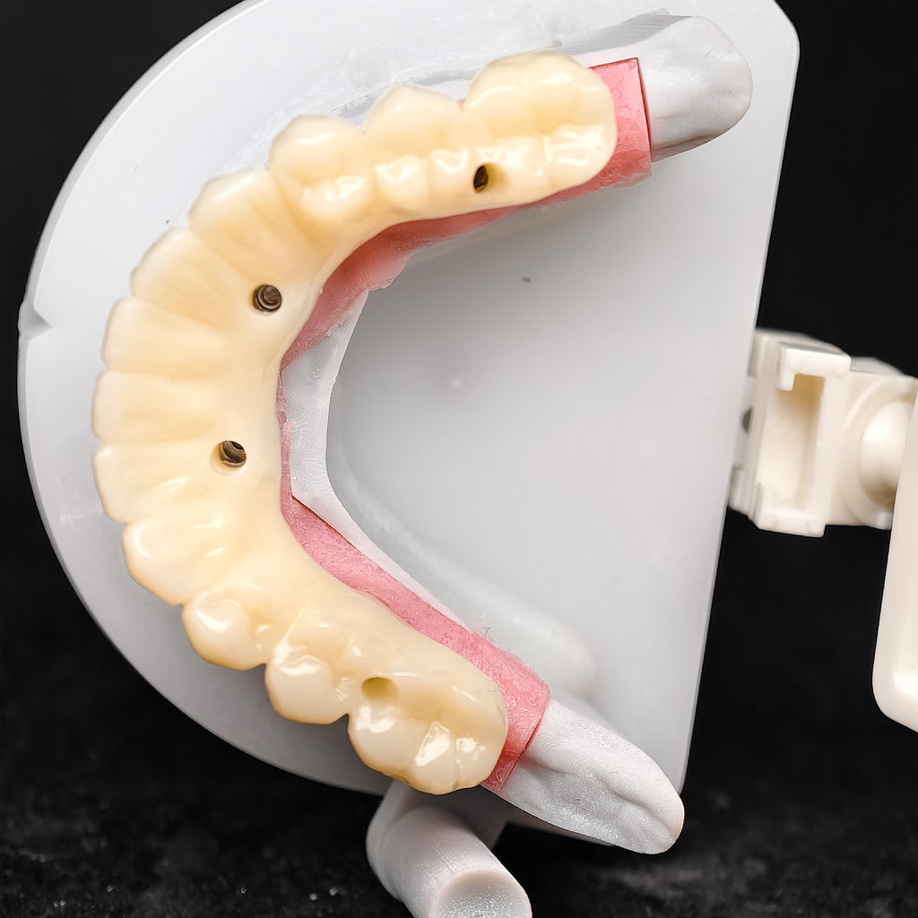 PMMA Bridge With Ti-Base Screw Retained Trying For Full Arch Restoration