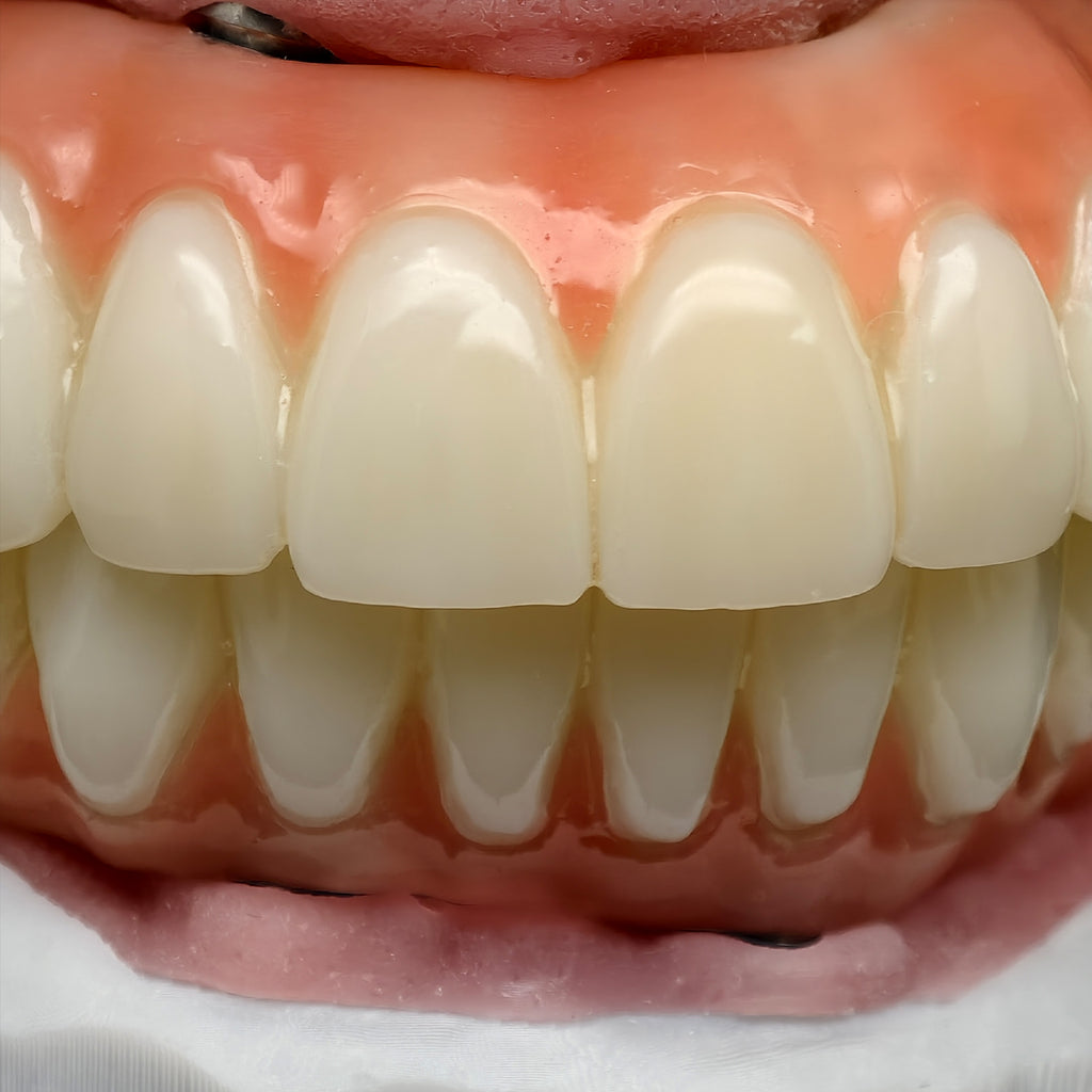 PMMA Bridge With Ti-Base Screw Retained Trying For Full Arch Restoration