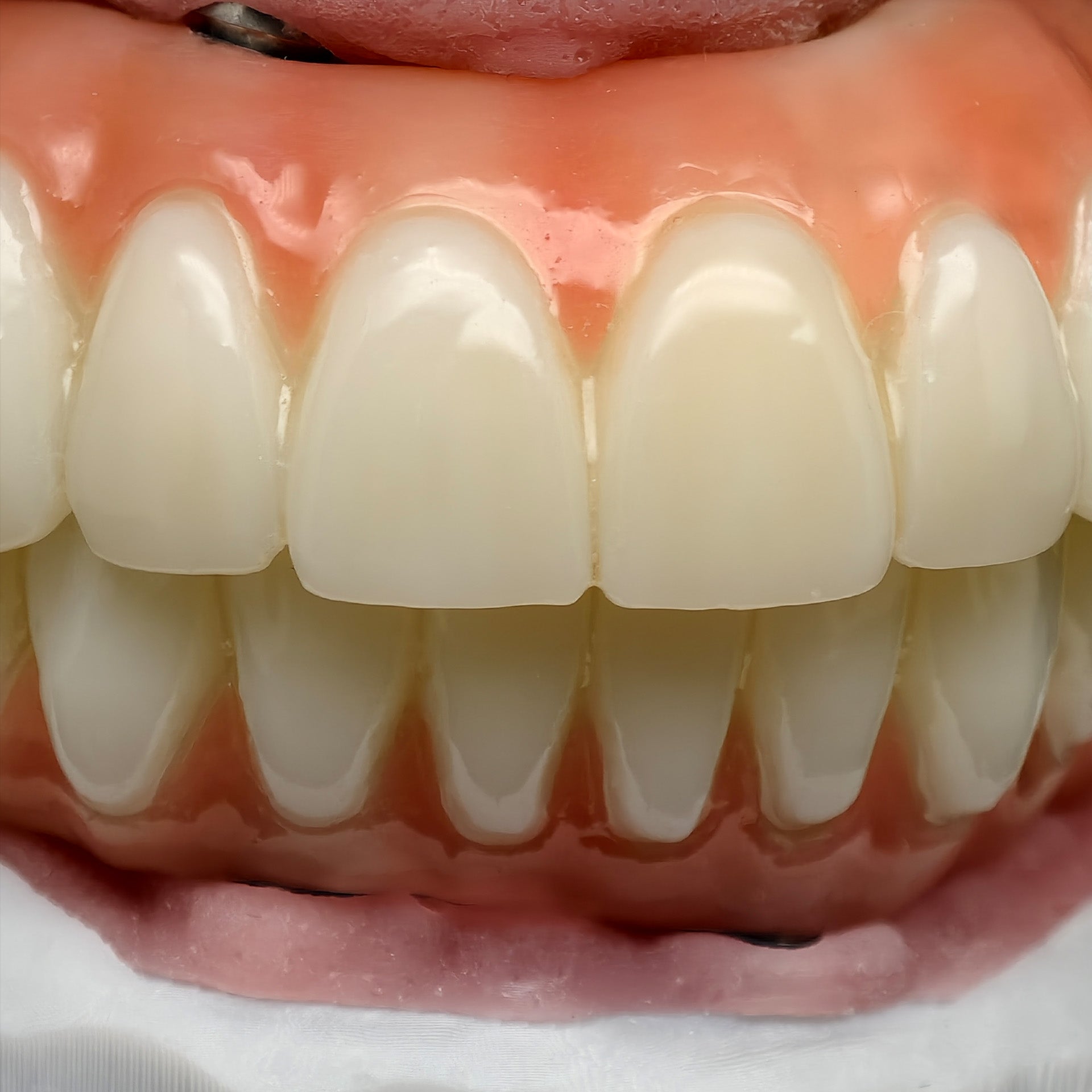 PMMA Bridge With Ti-Base Screw Retained Trying For Full Arch Restoration