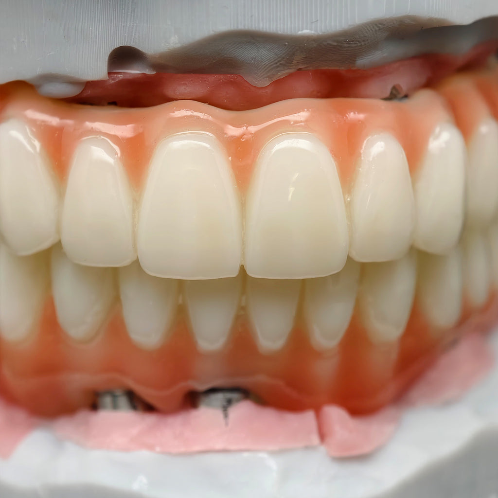PMMA Bridge With Ti-Base Screw Retained Trying For Full Arch Restoration