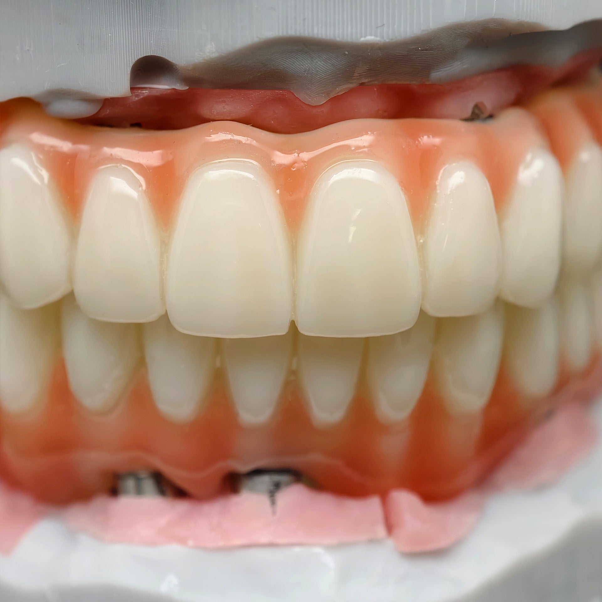 PMMA Bridge With Ti-Base Screw Retained Trying For Full Arch Restoration