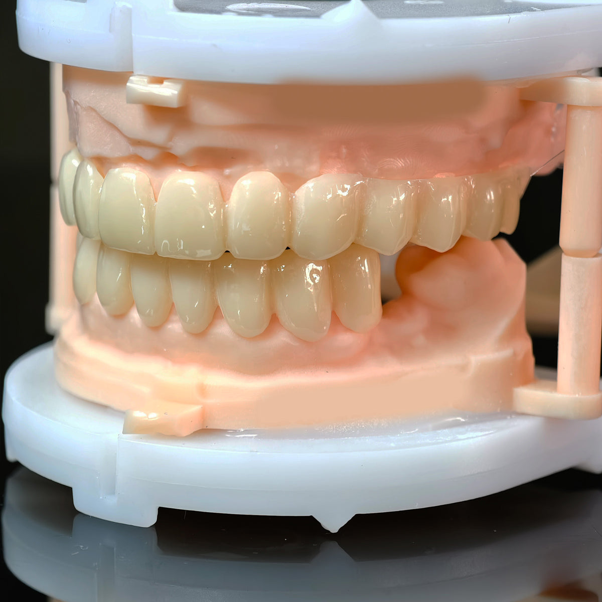 PMMA Bridge With Open Shell Preparing For Full Arch Dental Implants